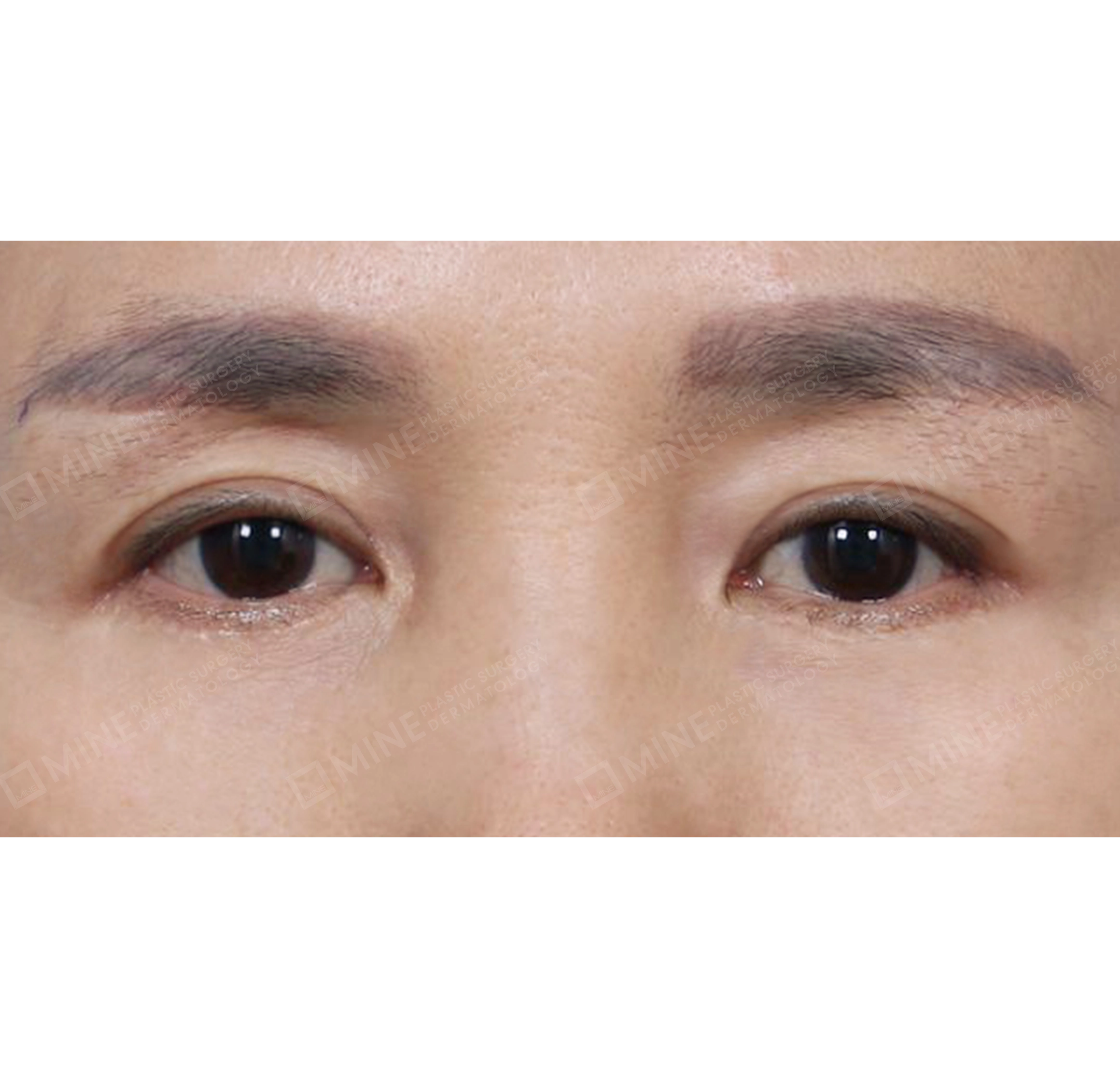 Upper & Lower Blepharoplasty + Subbrow Lift-정면-후
