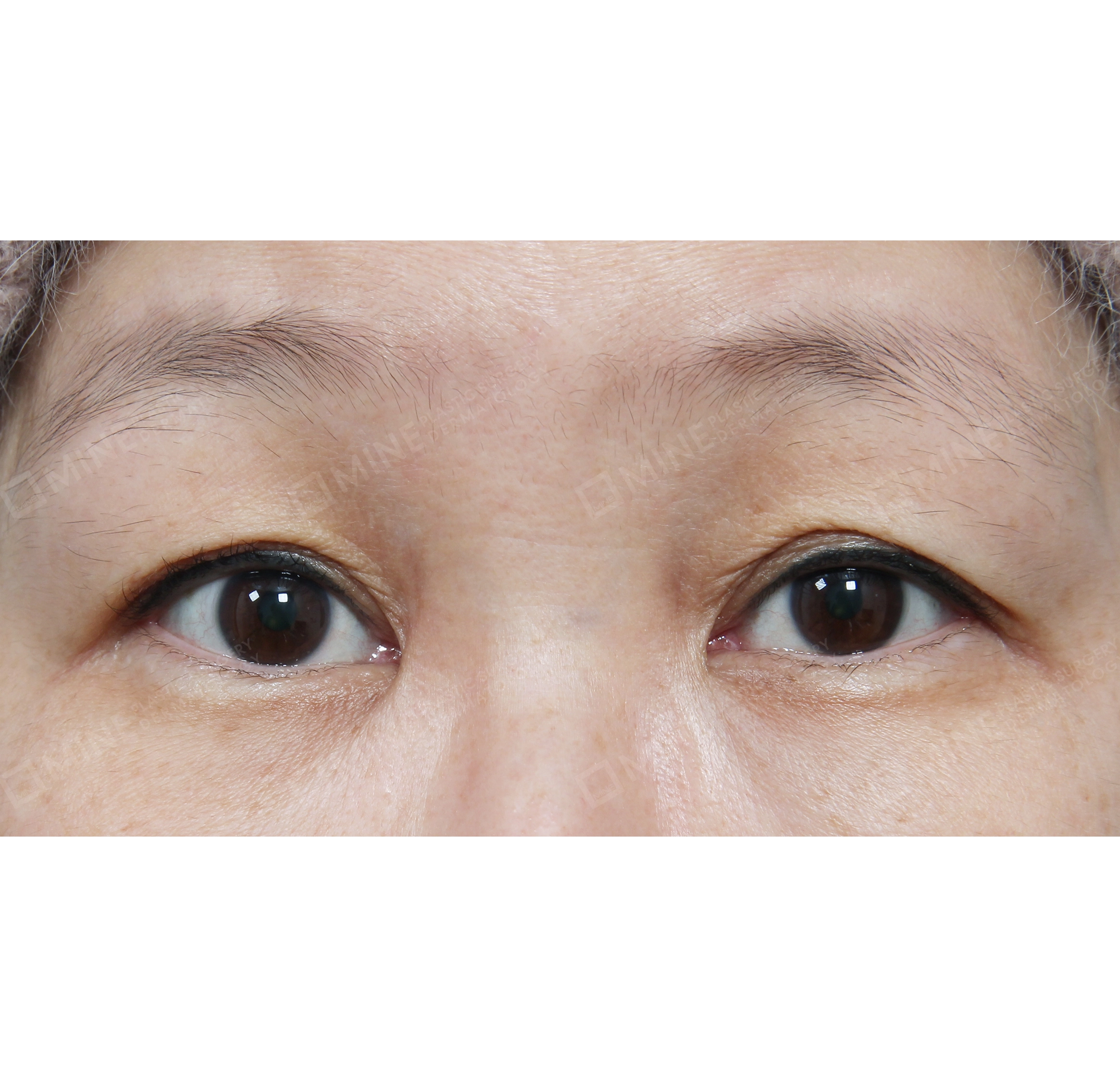 Ptosis Correction + Lateral Canthoplasty-정면-전