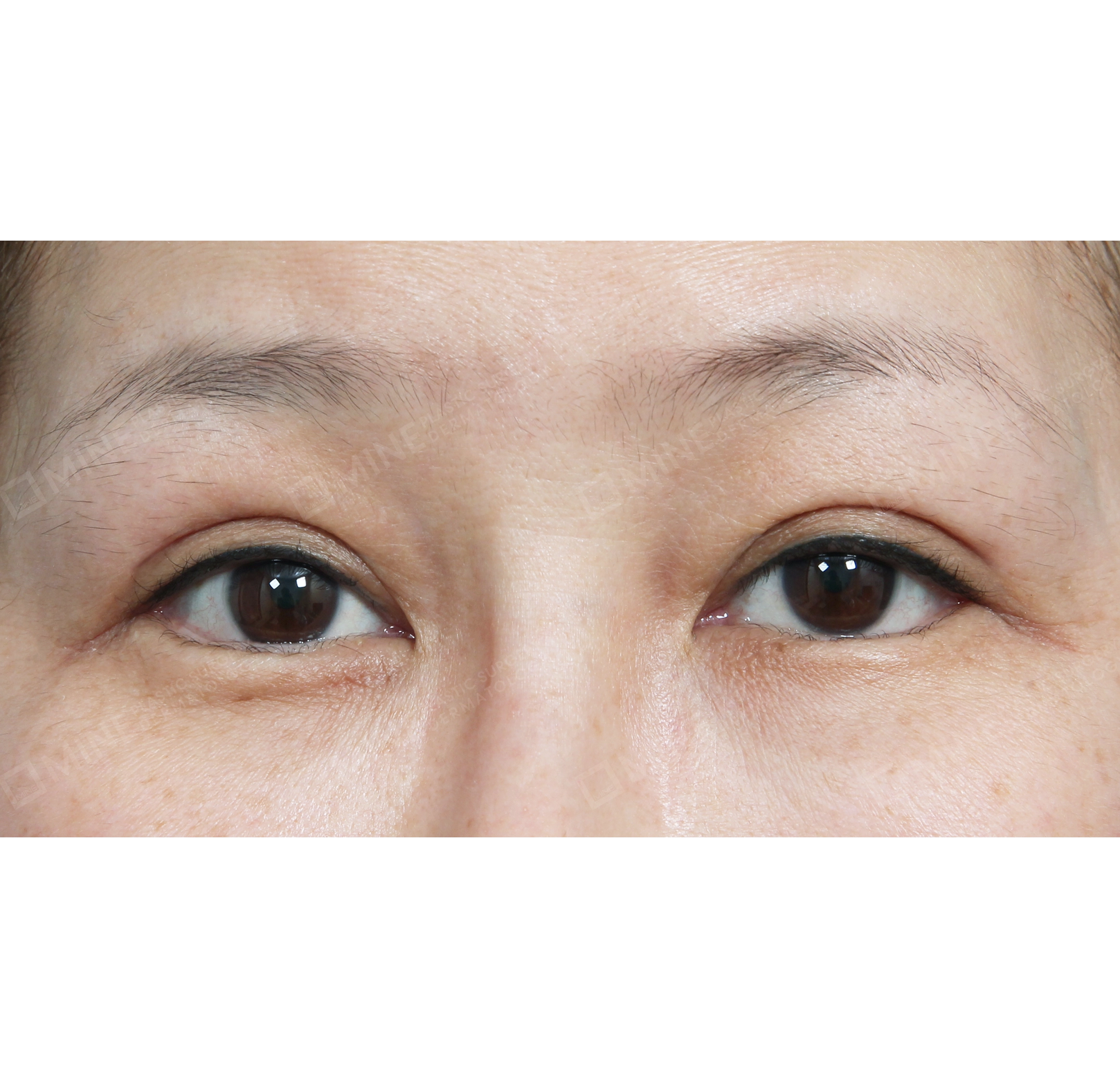 Ptosis Correction + Lateral Canthoplasty-정면-후