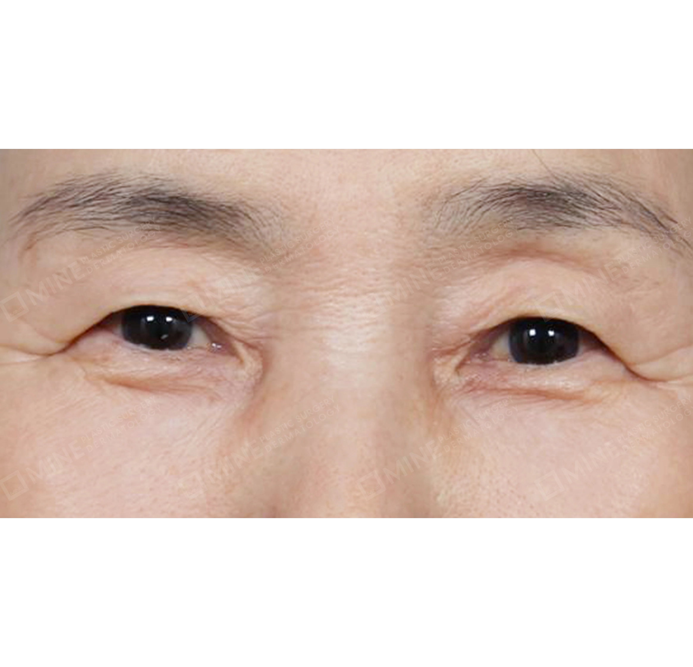 Upper Blepharoplasty + Under Eye Fat Repositioning-정면-전
