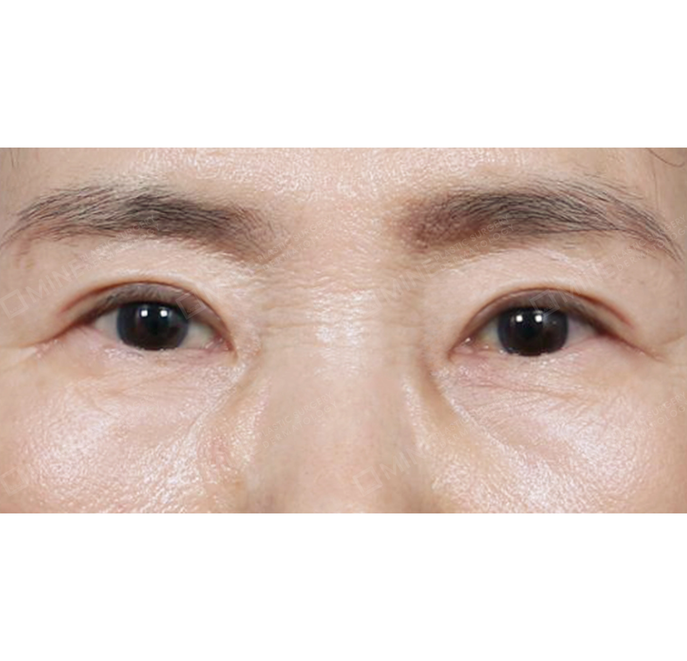 Upper Blepharoplasty + Under Eye Fat Repositioning-정면-후