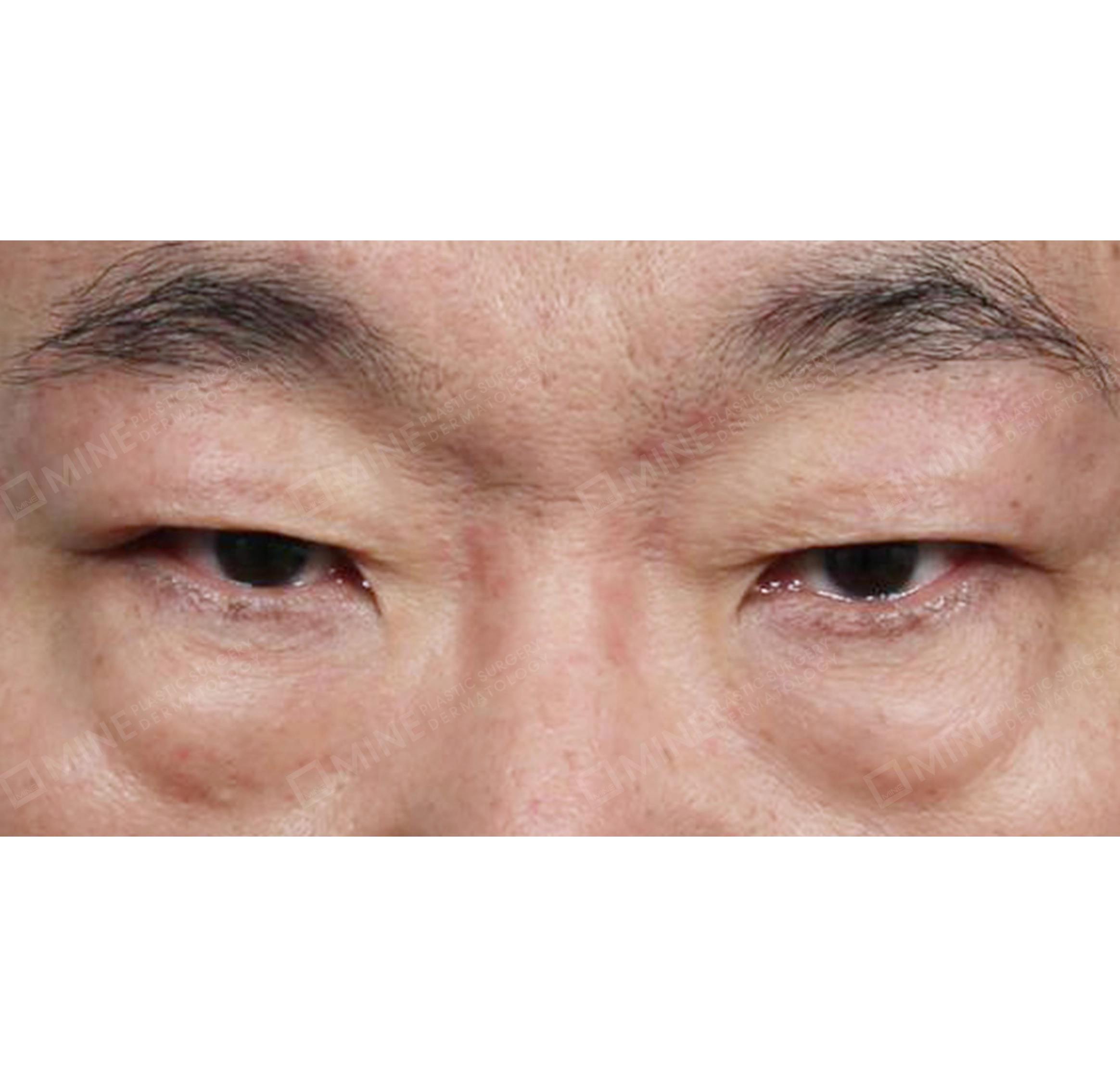 Subbrow Lift + Lower Blepharoplasty + Upper Eyelid Fat Removal-정면-전