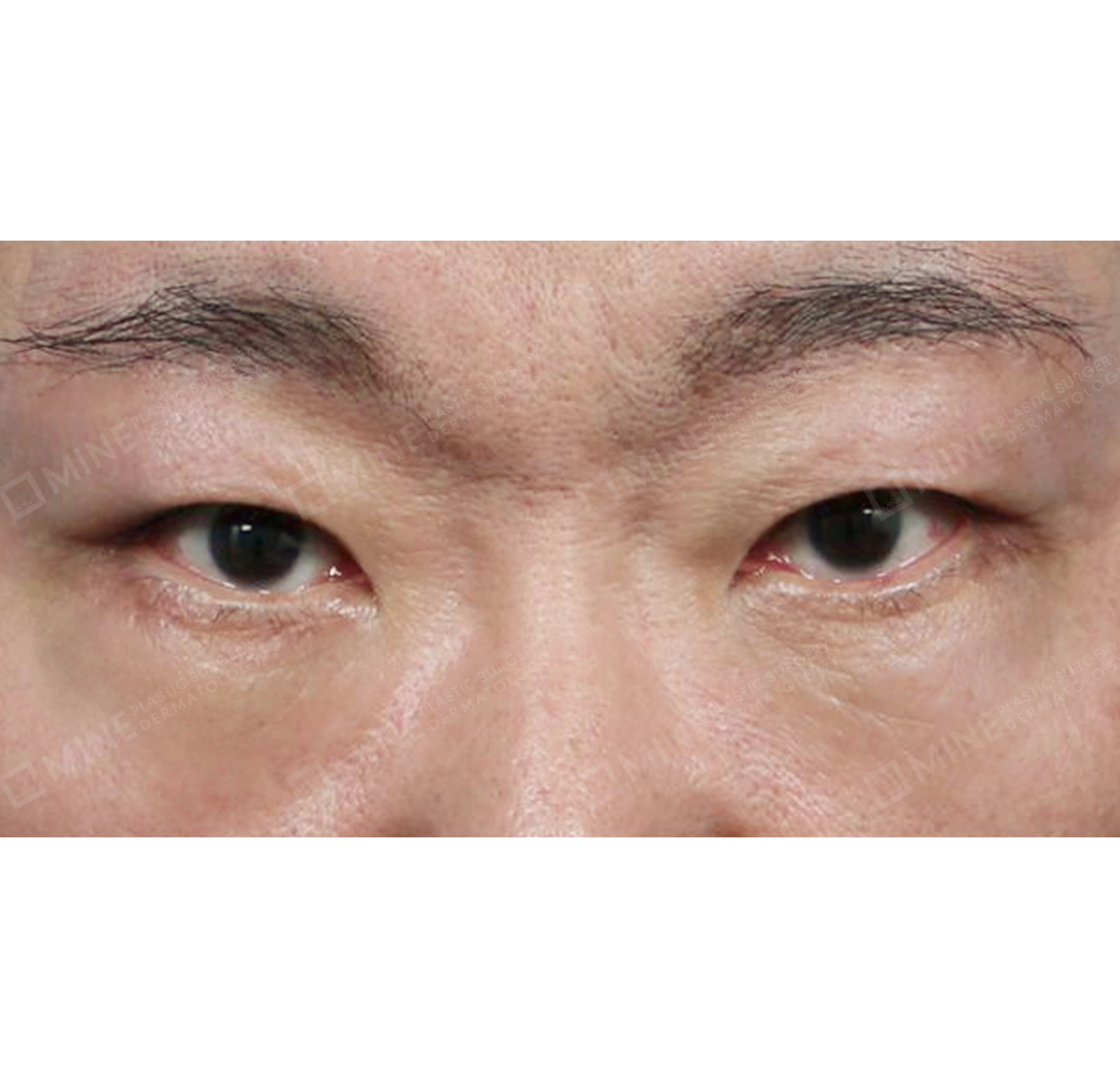 Subbrow Lift + Lower Blepharoplasty + Upper Eyelid Fat Removal-정면-후