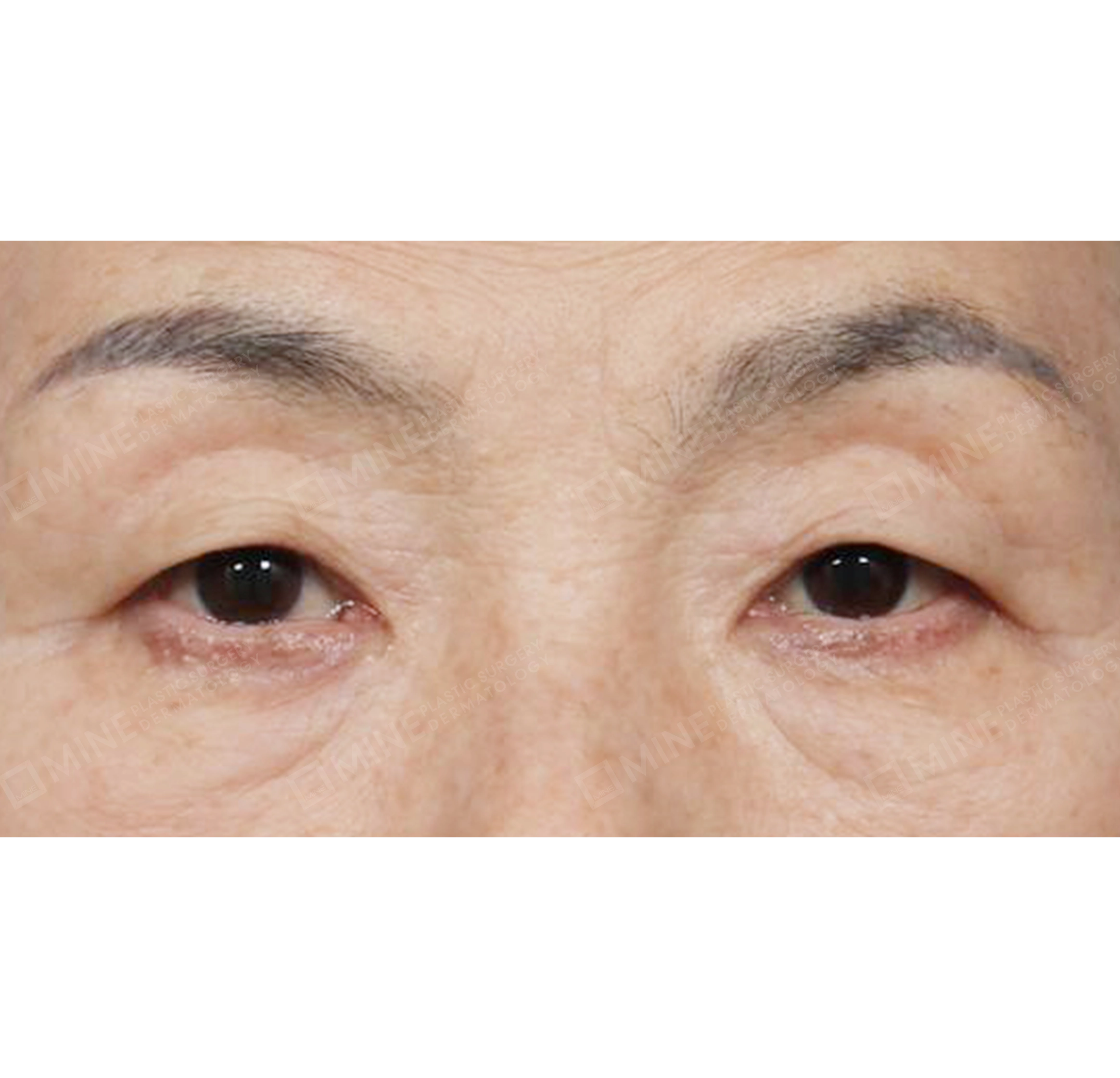 Upper & Lower Blepharoplasty + Subbrow Lift-정면-전