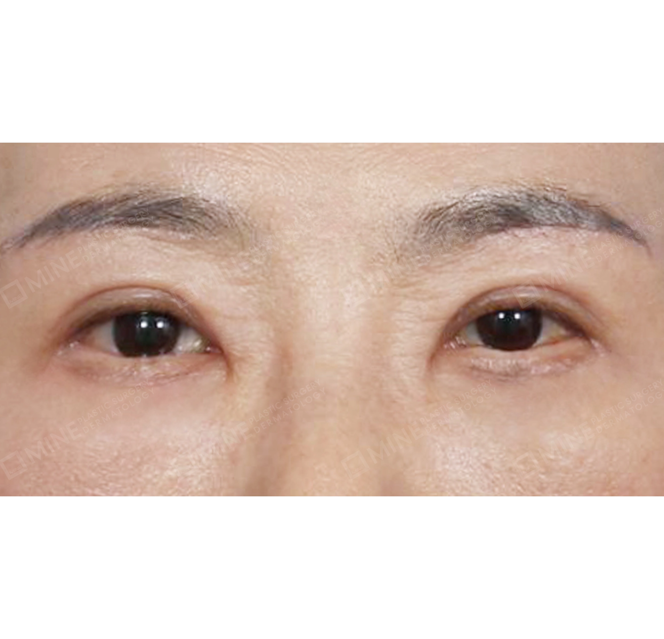 Upper & Lower Blepharoplasty + Subbrow Lift-정면-후
