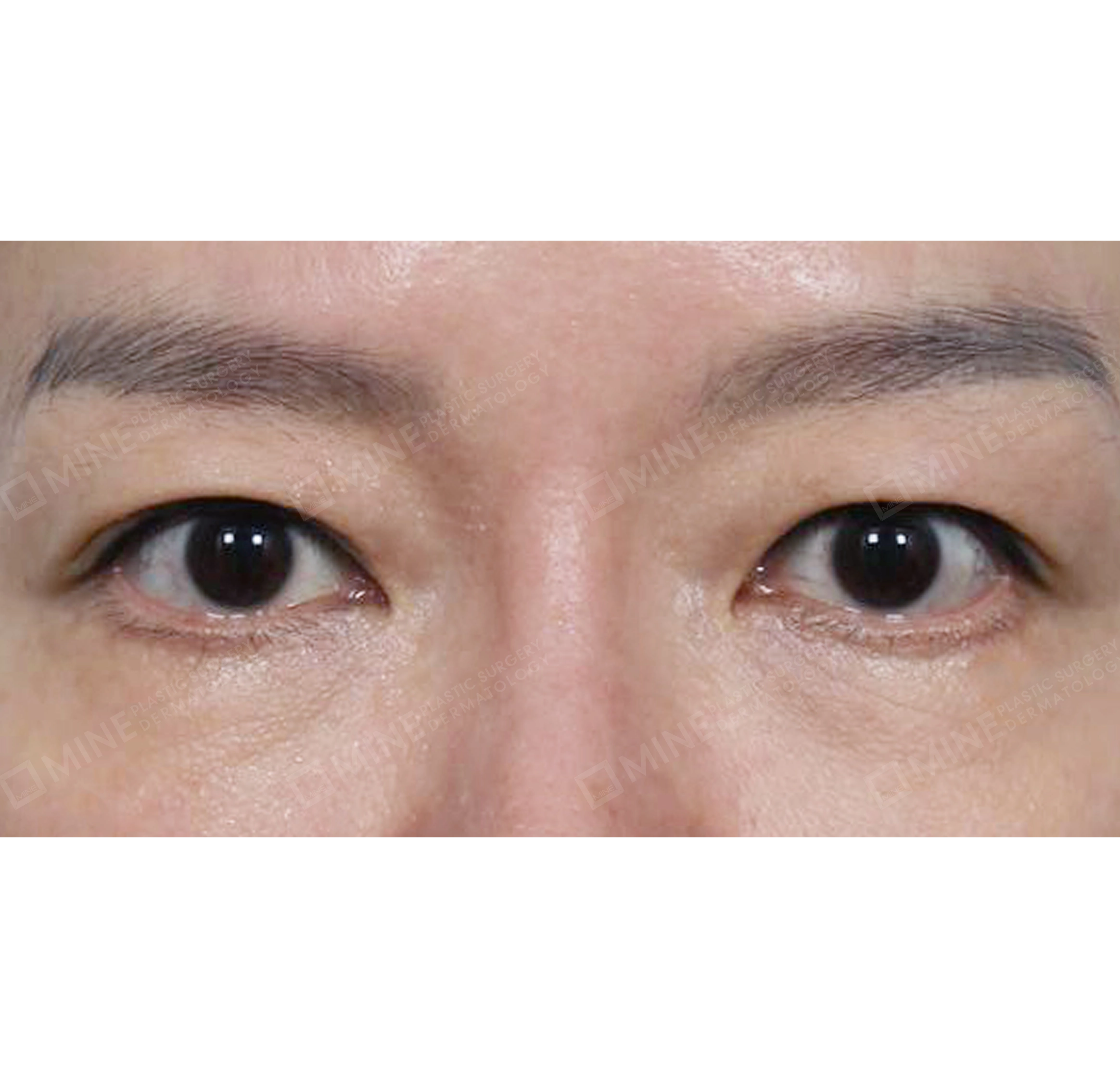 Subbrow Lift + Revision Lower Blepharoplasty-정면-전