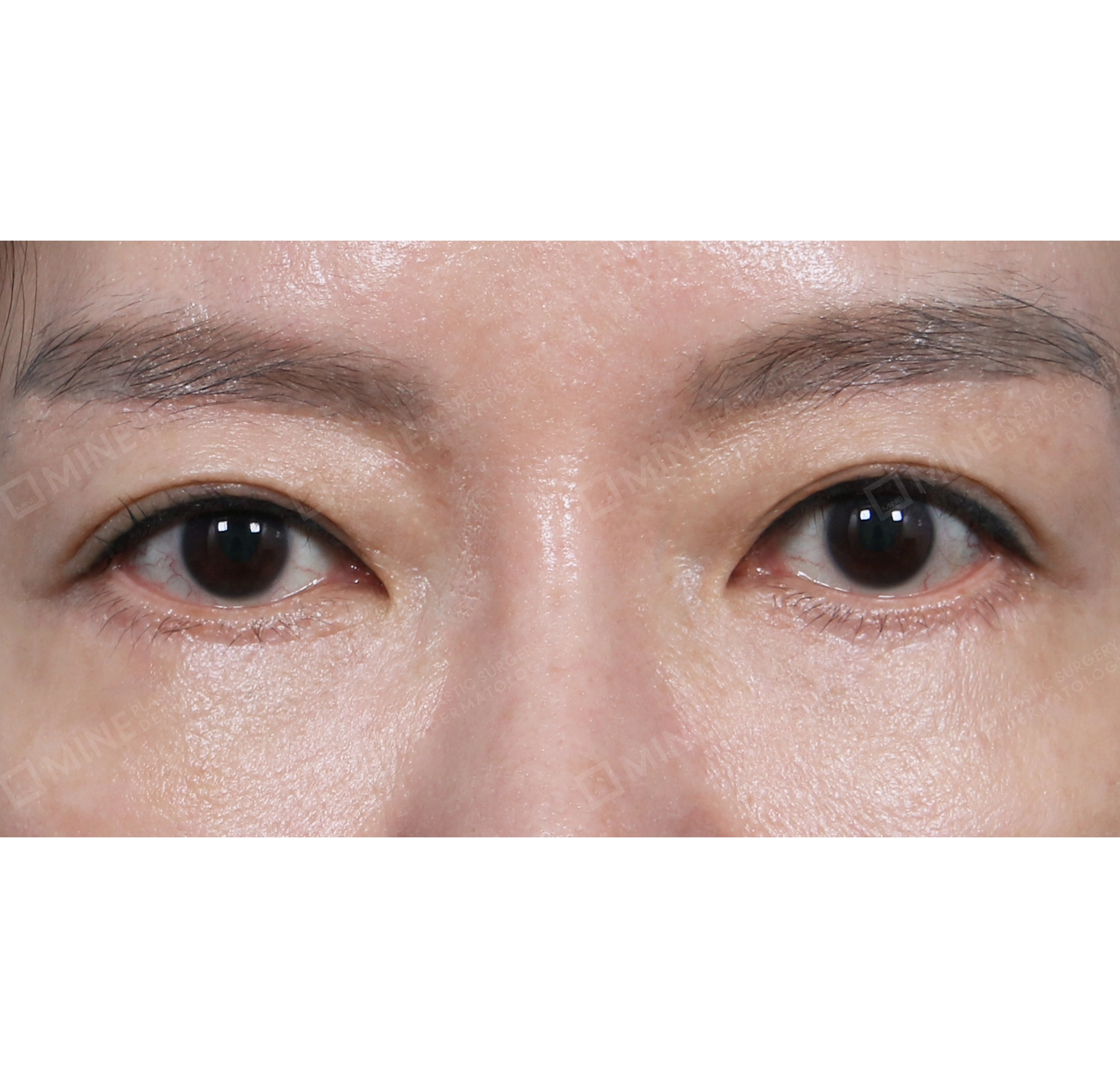 Subbrow Lift + Revision Lower Blepharoplasty-정면-후
