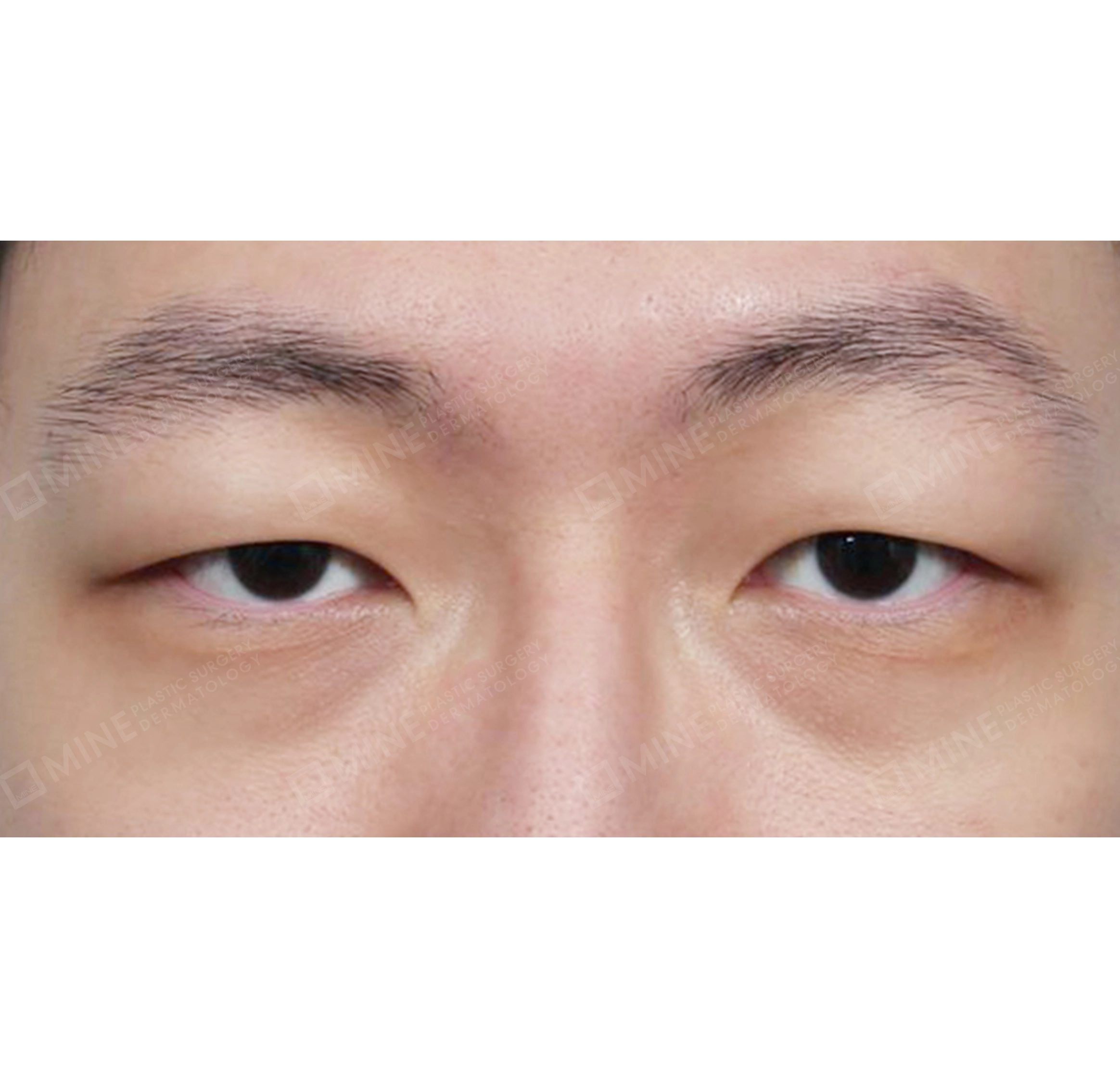 Incision Ptosis Correction-정면-전