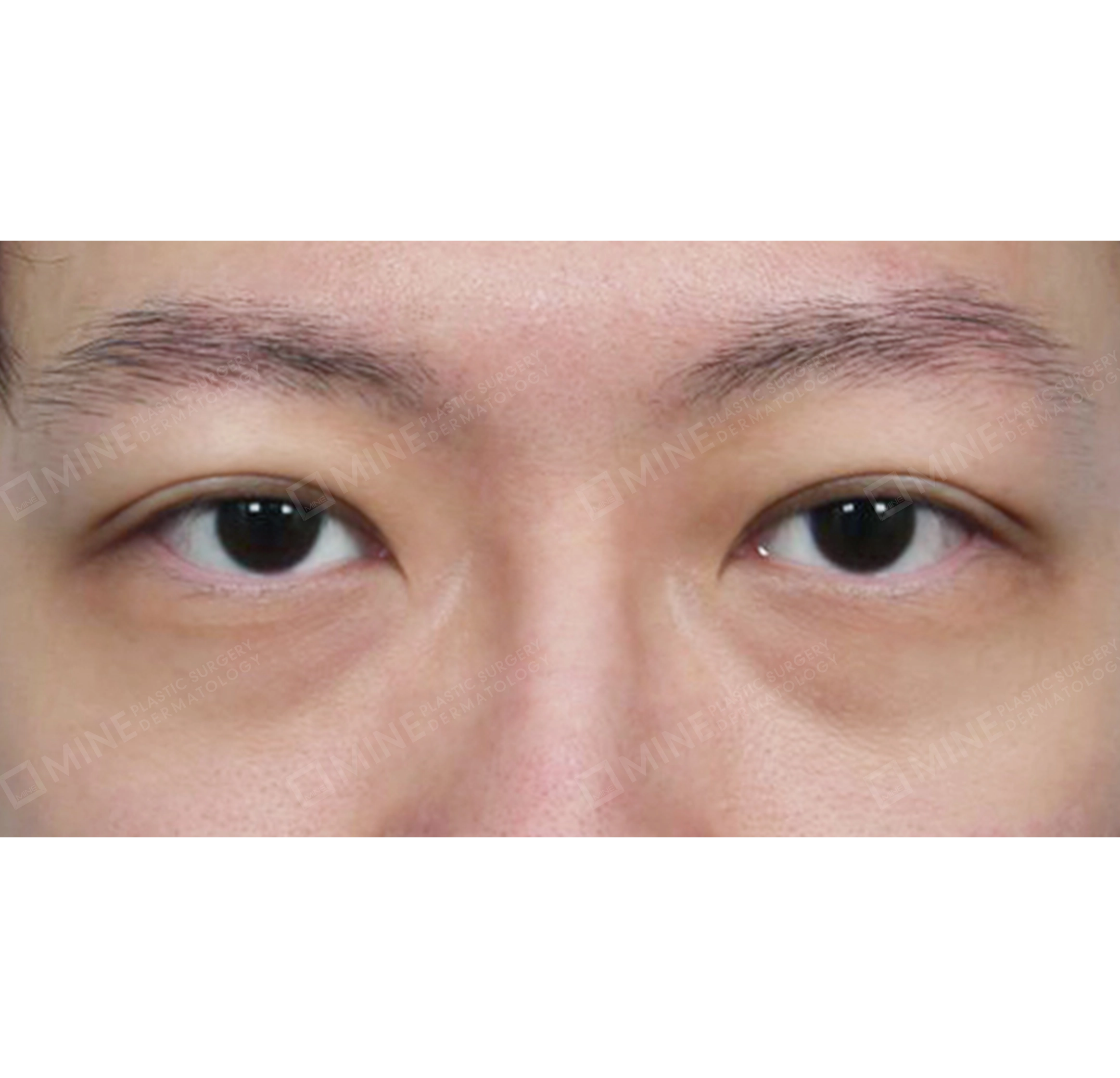 Incision Ptosis Correction-정면-후