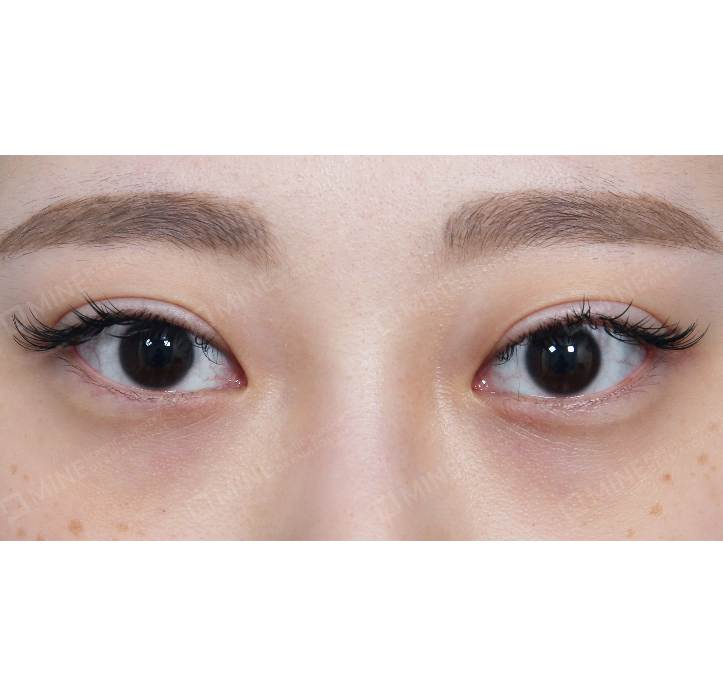 Lateral Canthoplasty-정면-전
