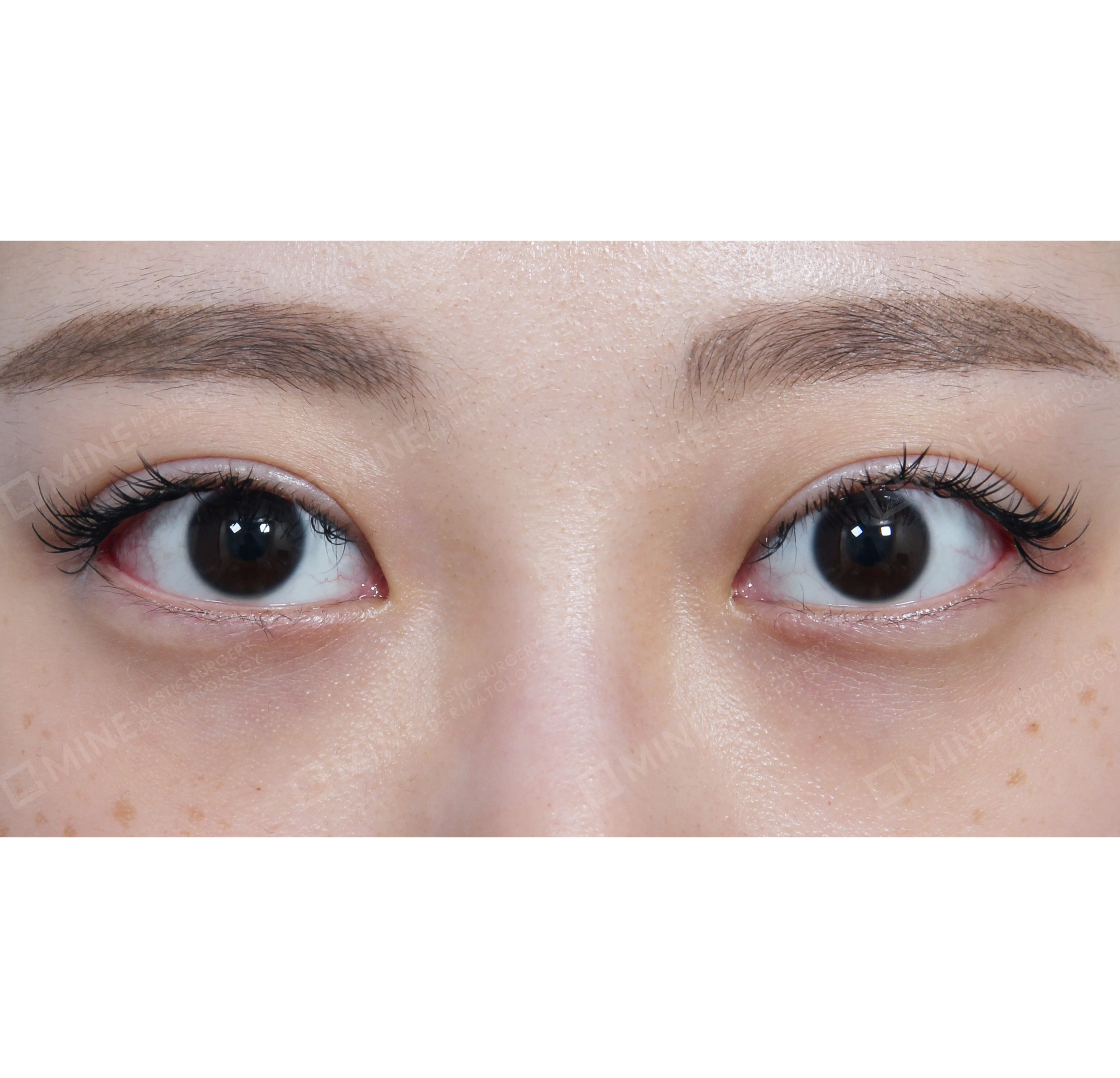 Lateral Canthoplasty-정면-후
