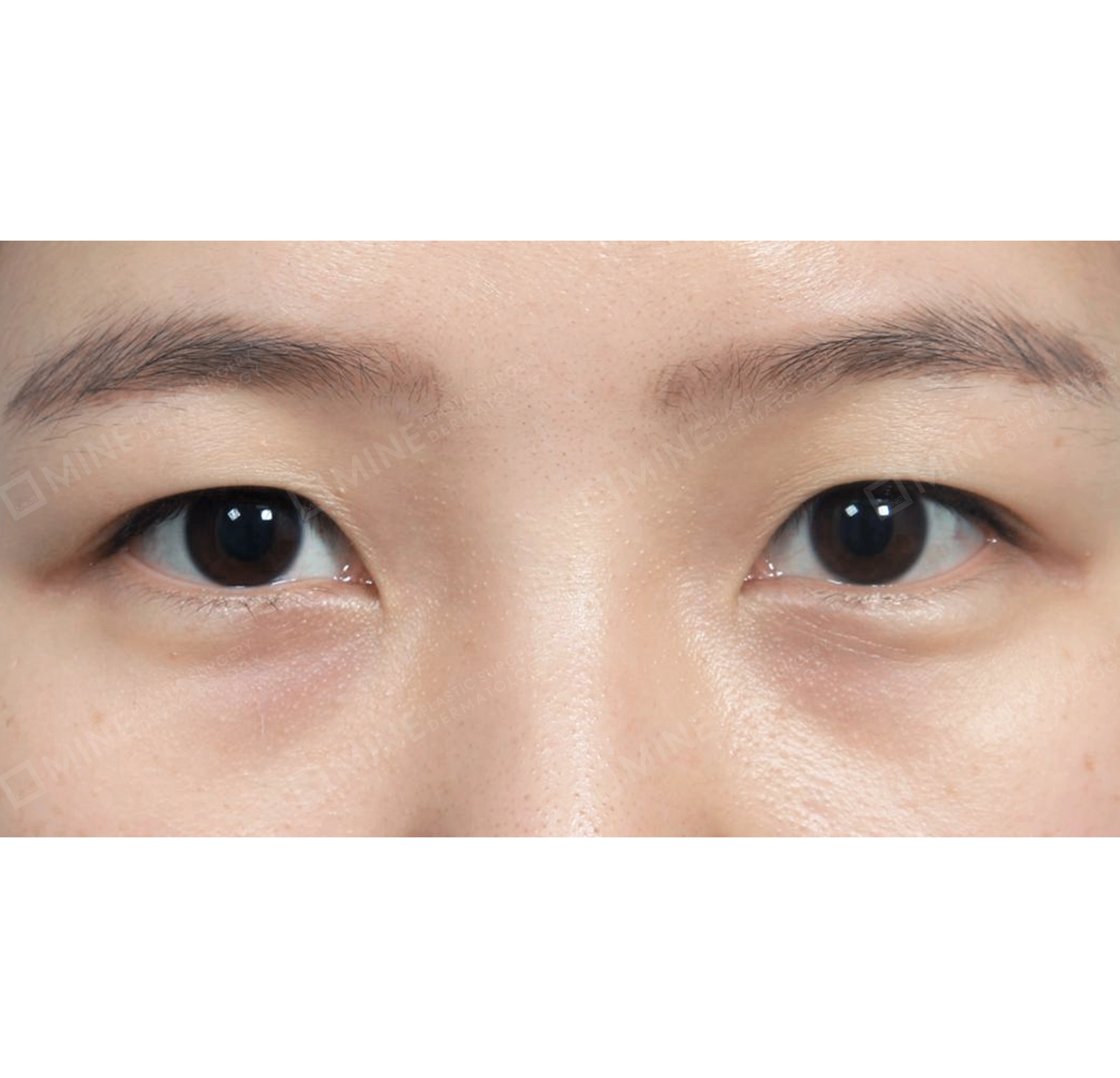 Non-incision Double Eyelid + Epi Canthoplasty-정면-전