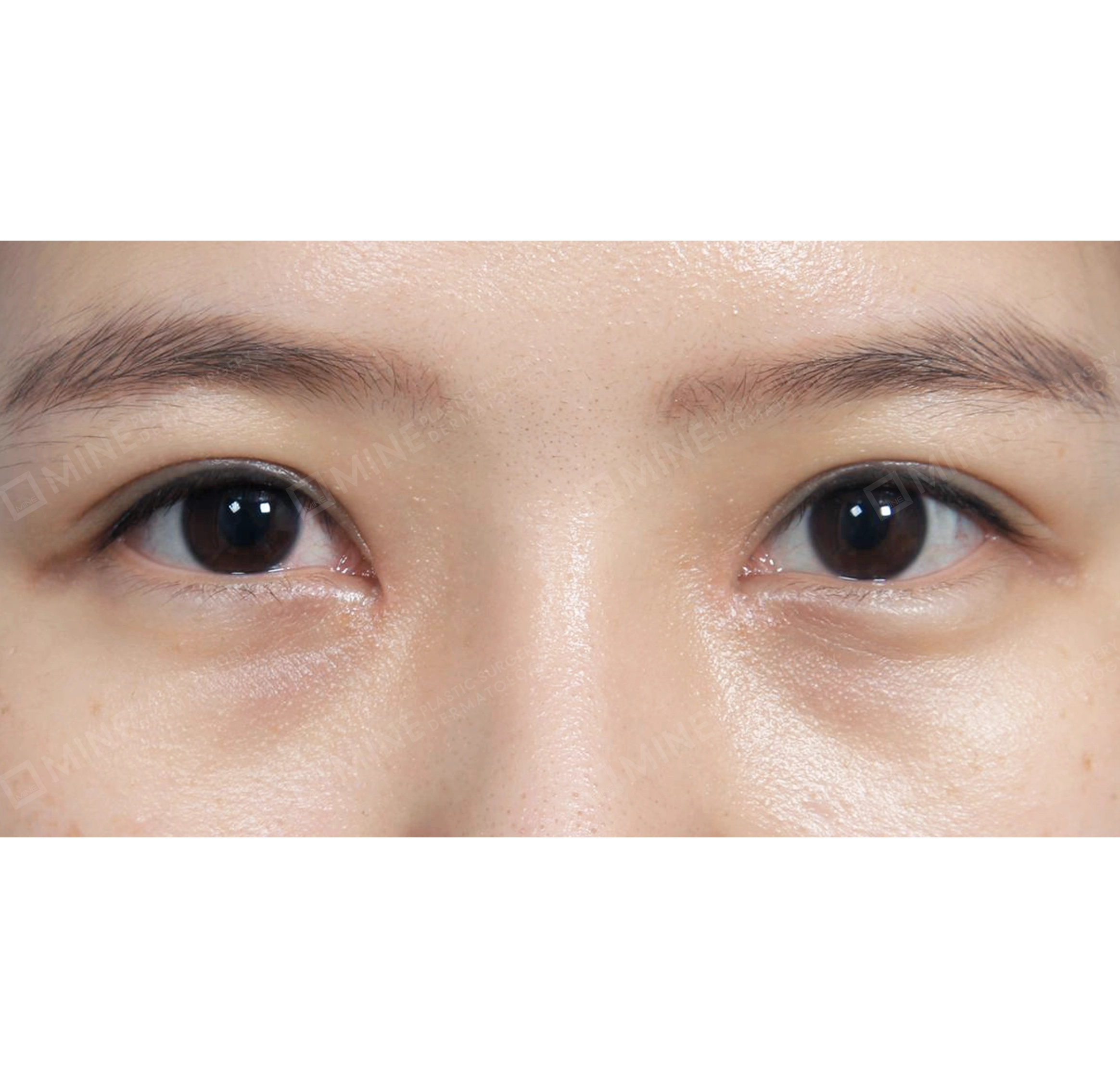 Non-incision Double Eyelid + Epi Canthoplasty-정면-후
