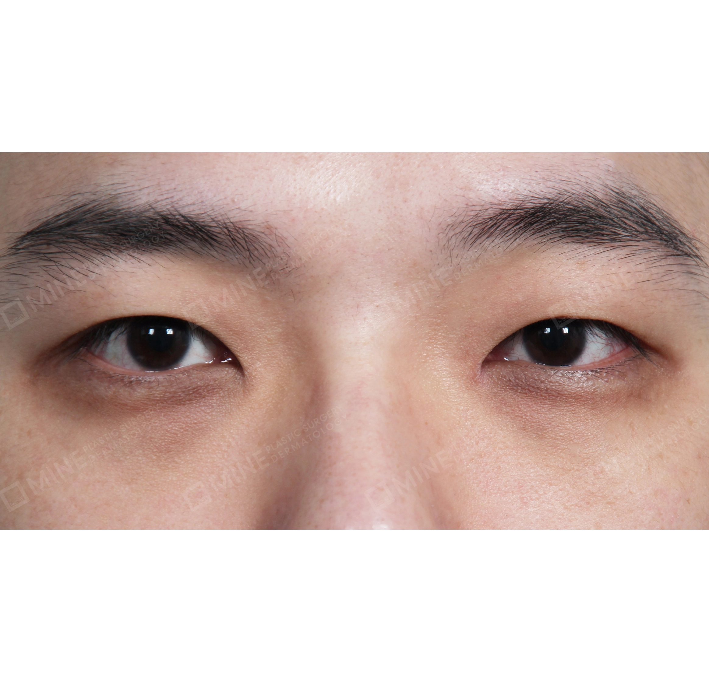 Non-incision Double Eyelid + Epi Canthoplasty-정면-전