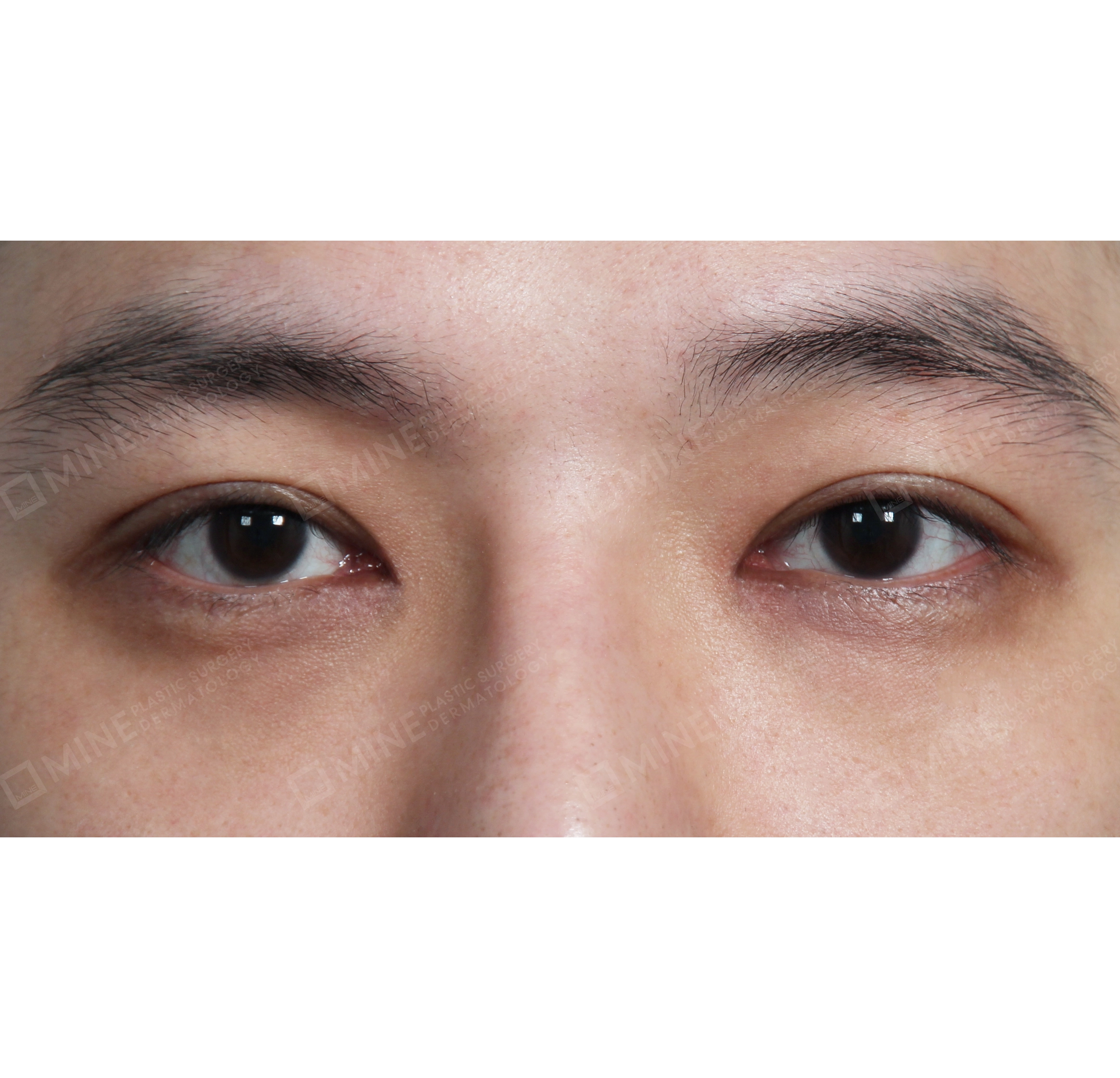 Non-incision Double Eyelid + Epi Canthoplasty-정면-후