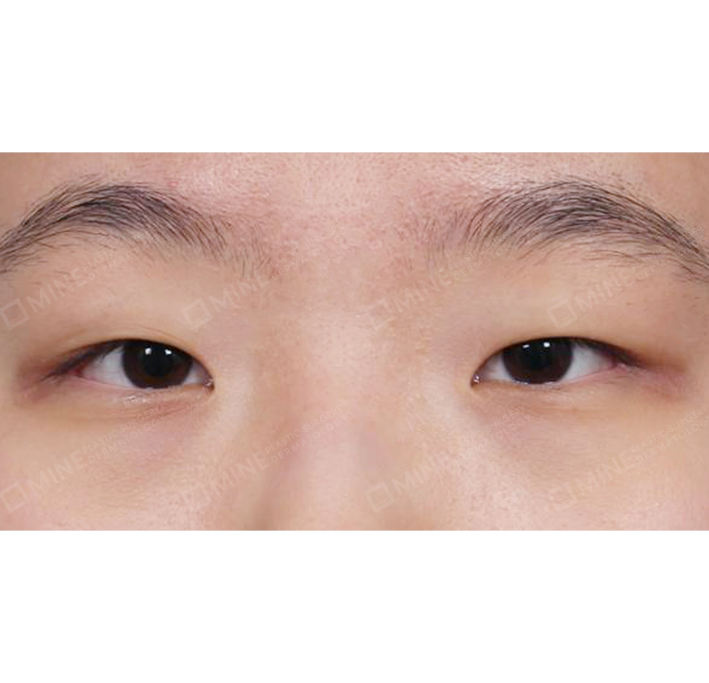 Incision Ptosis Correction + Epi Canthoplasty-정면-전