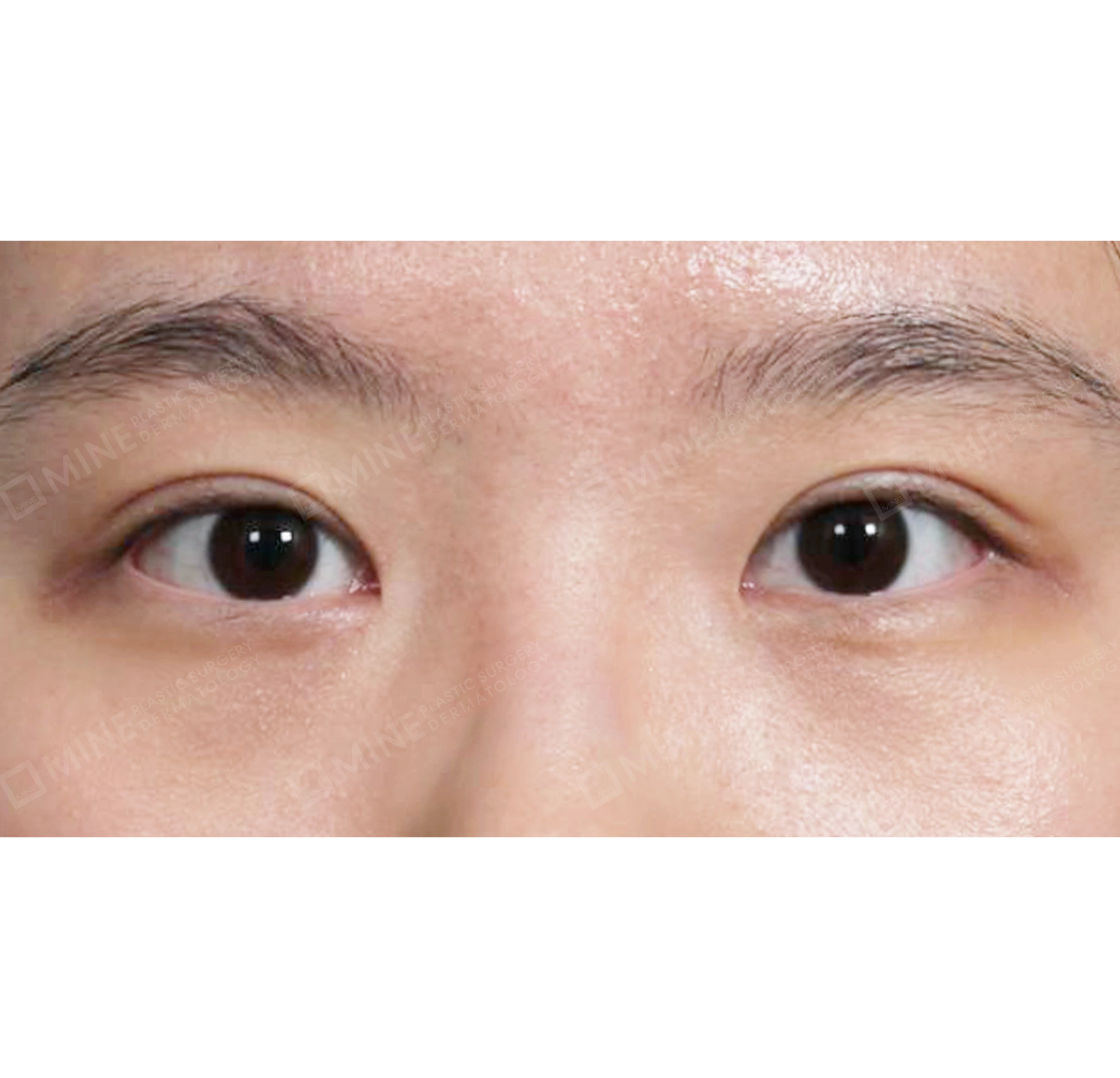 Incision Ptosis Correction + Epi Canthoplasty-정면-후