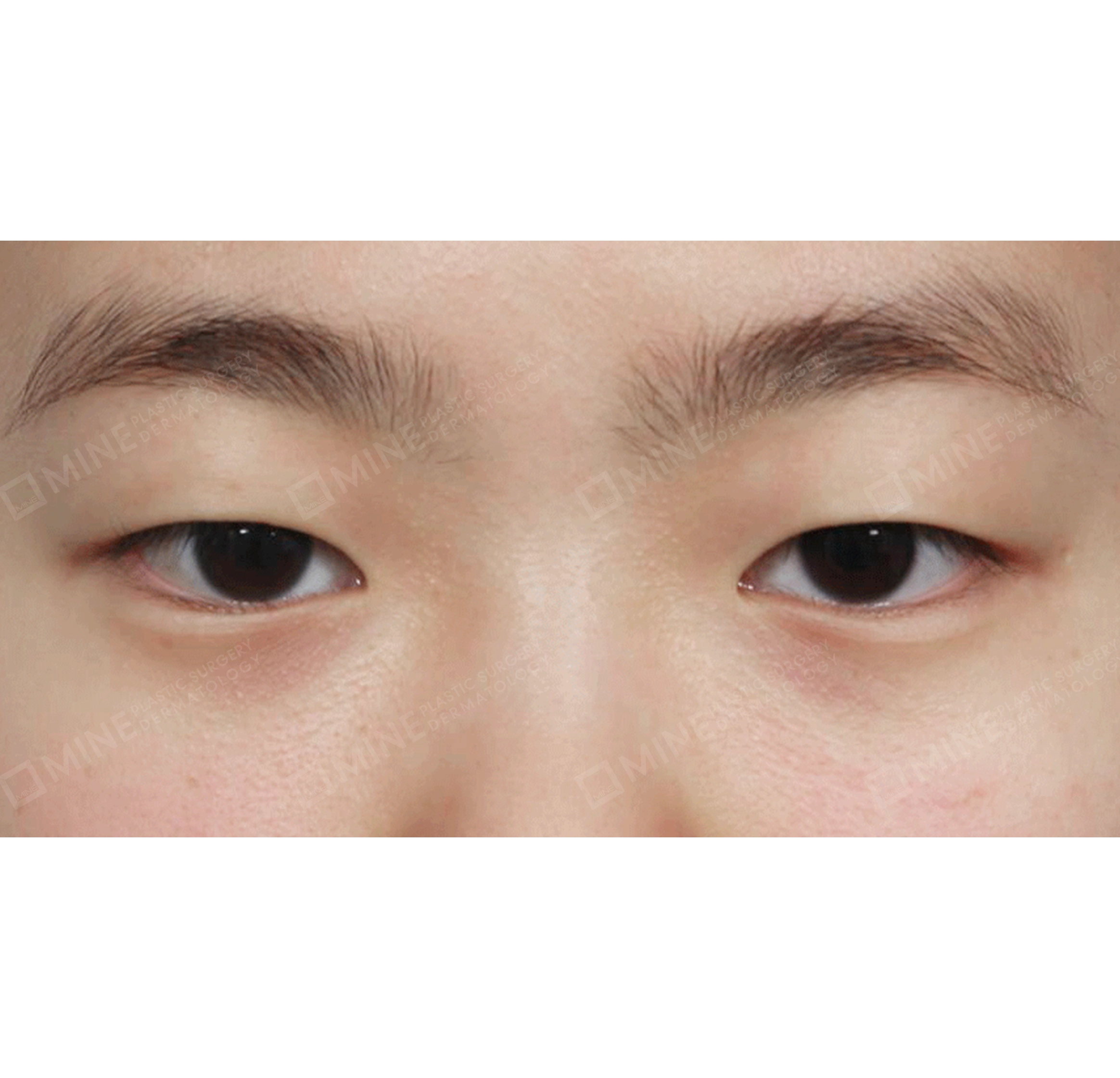 Partial Incision Ptosis Correction + Epi & Lateral & Lower Canthoplasty-정면-전