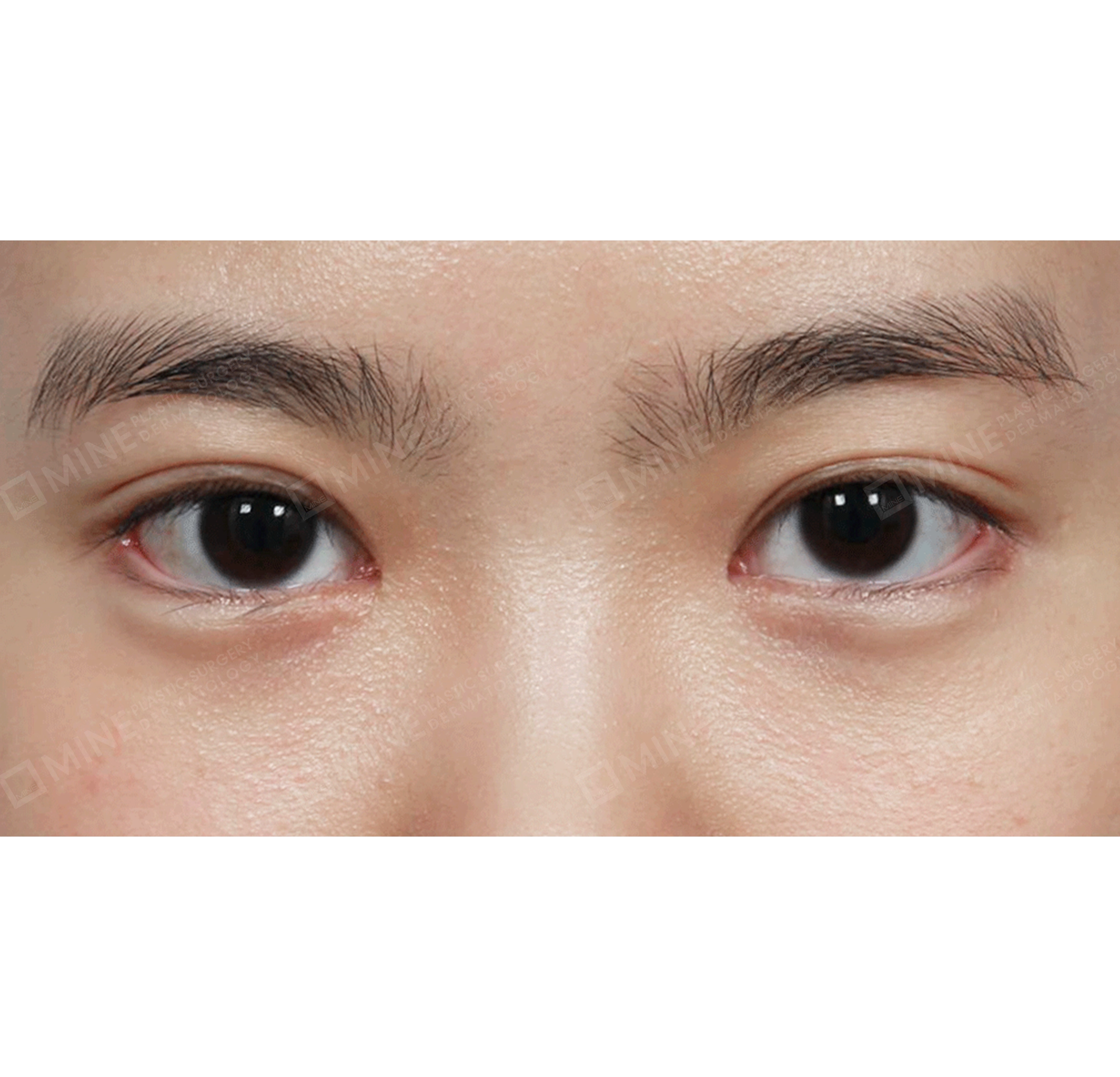 Partial Incision Ptosis Correction + Epi & Lateral & Lower Canthoplasty-정면-후