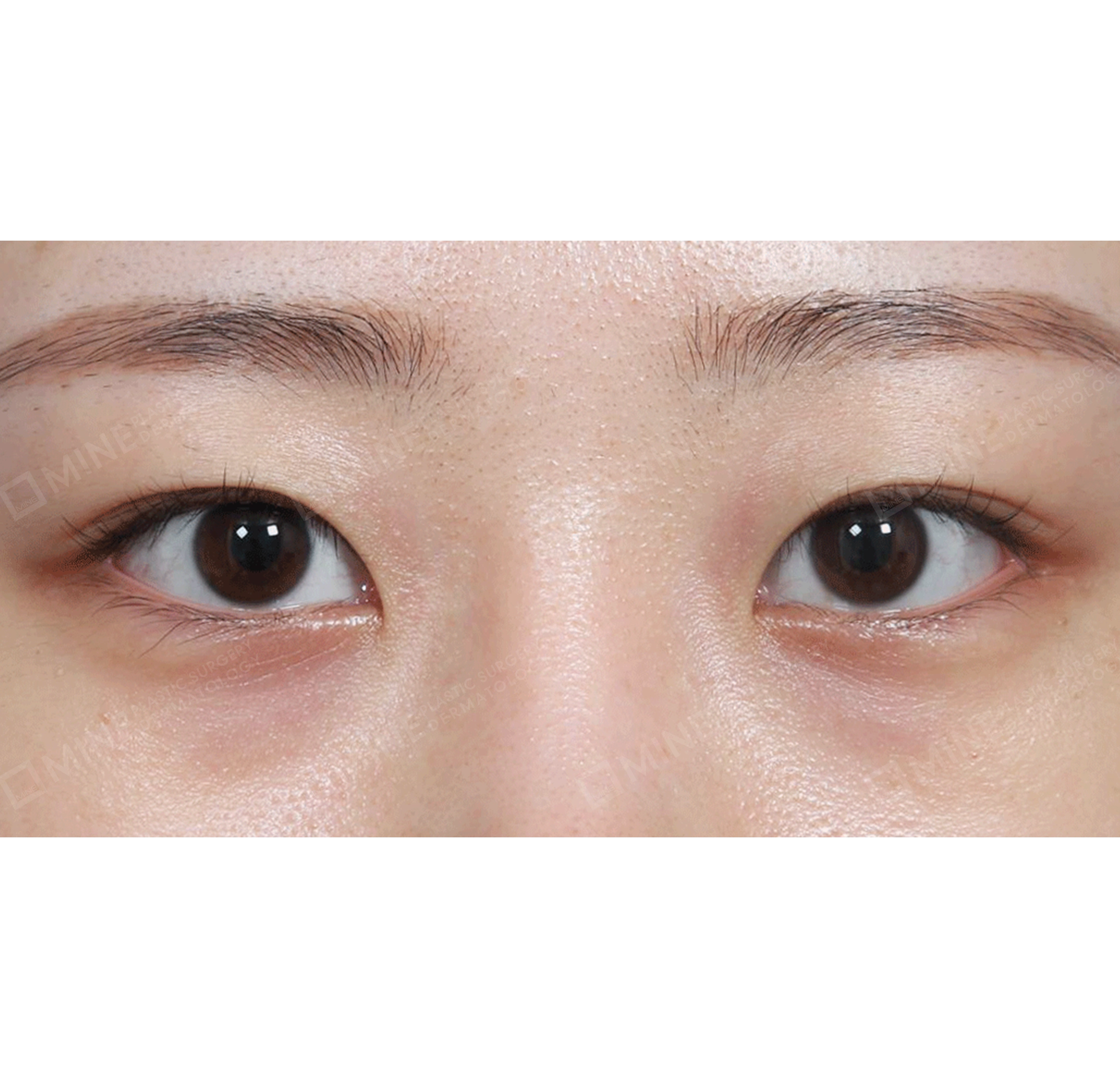 Non-incision Ptosis Correction + Epi Canthoplasty-정면-전