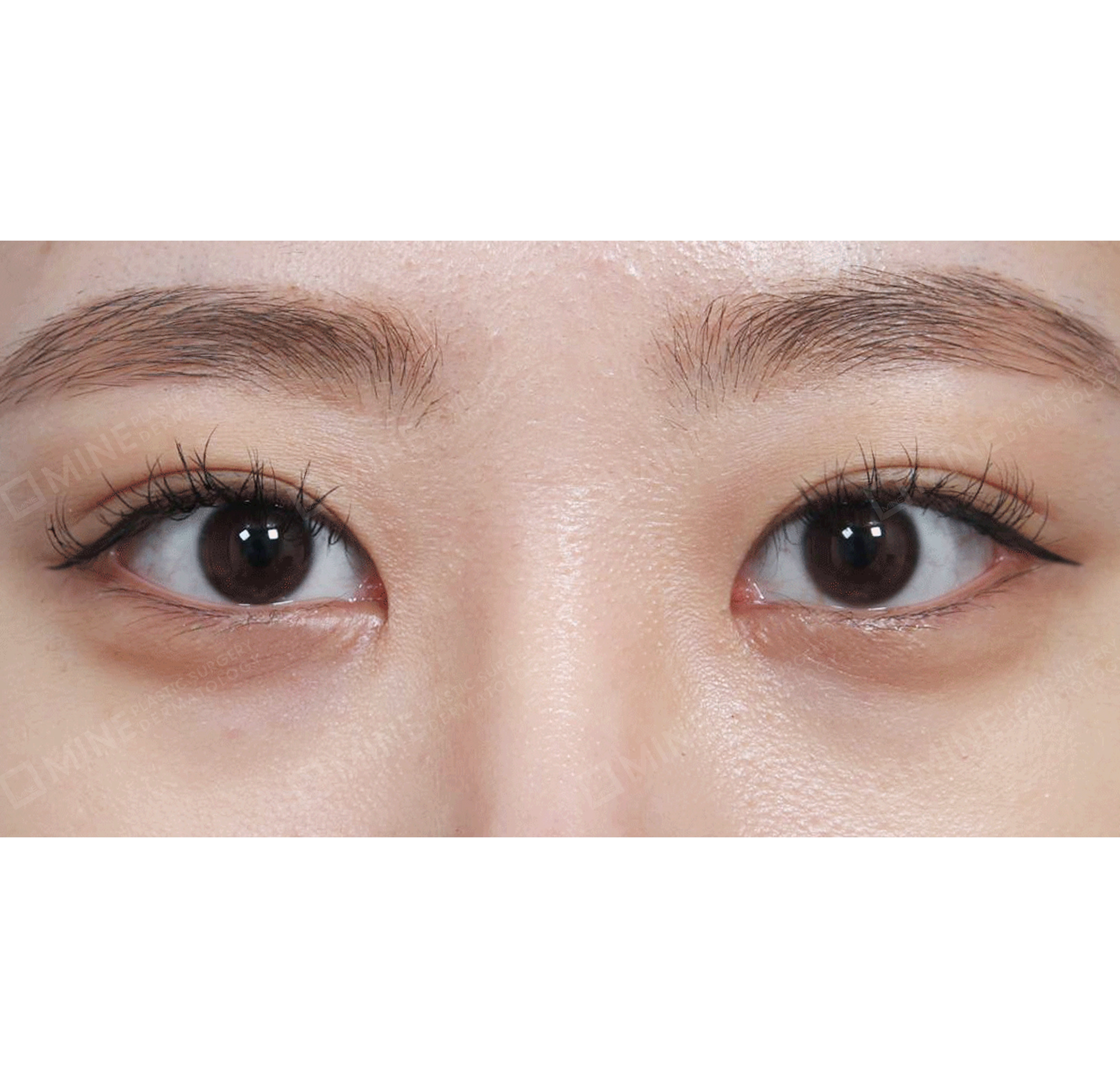 Non-incision Ptosis Correction + Epi Canthoplasty-정면-후