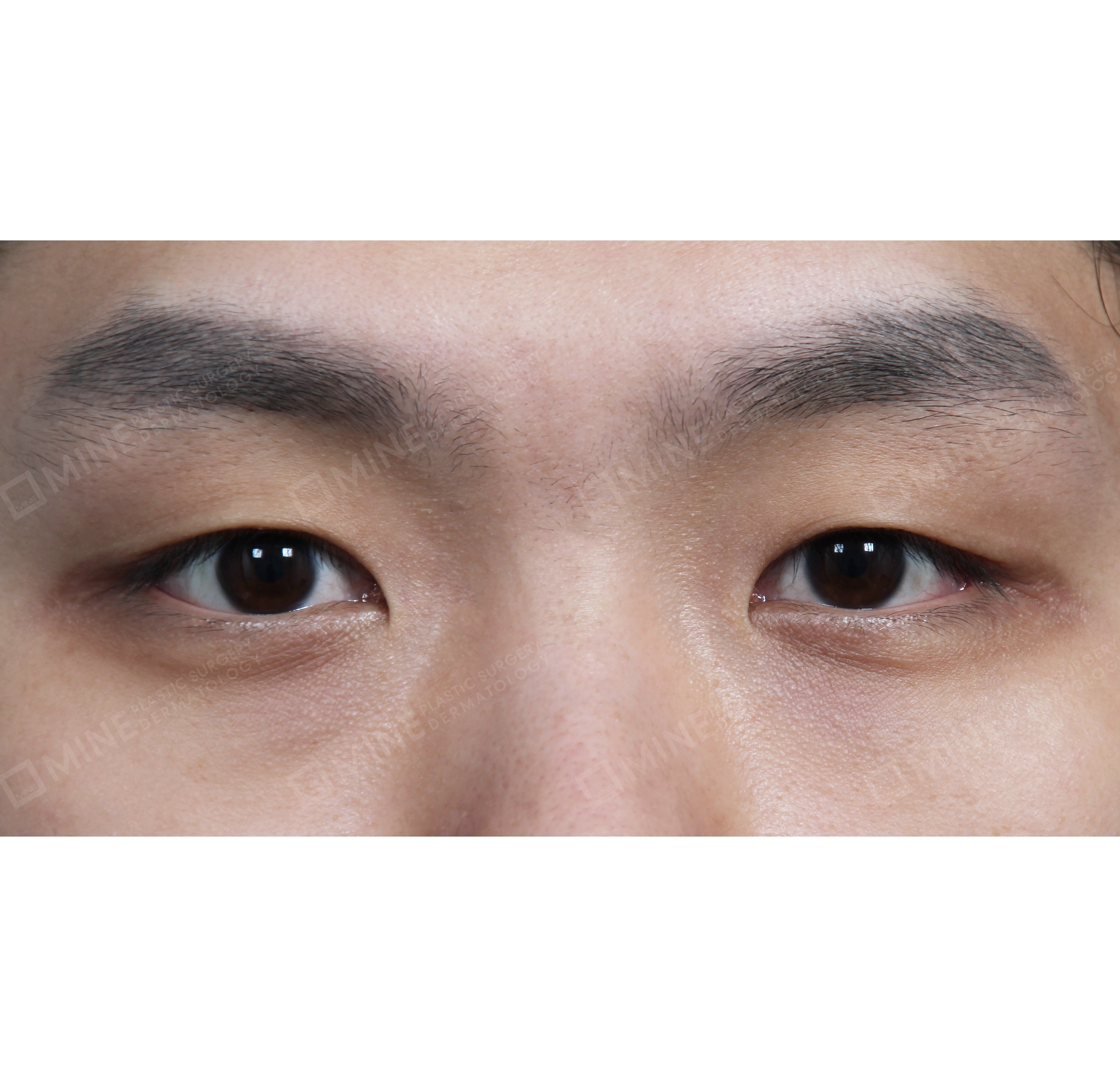 Non-incision Double Eyelid + Epi Canthoplasty-정면-전