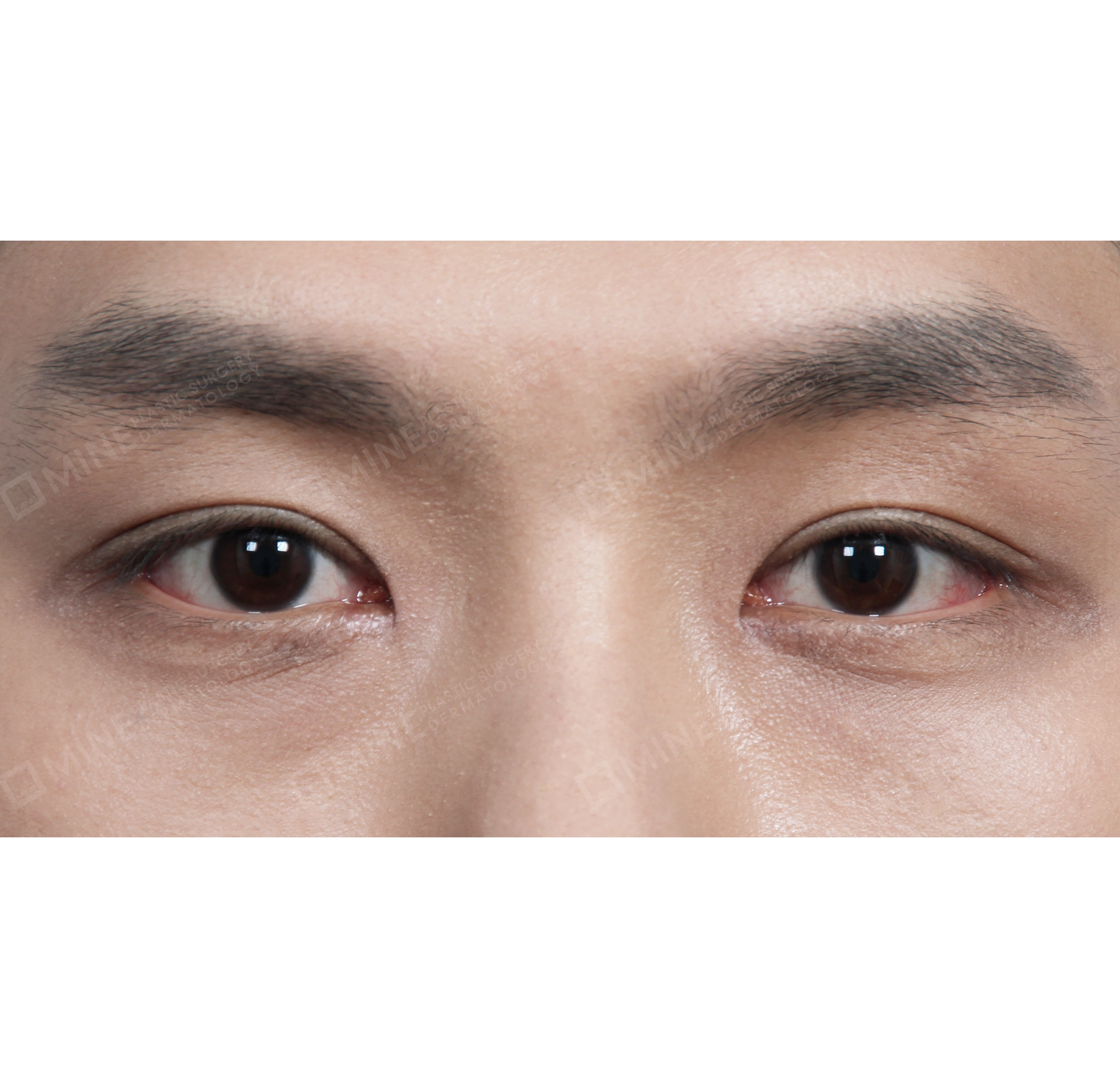 Non-incision Double Eyelid + Epi Canthoplasty-정면-후
