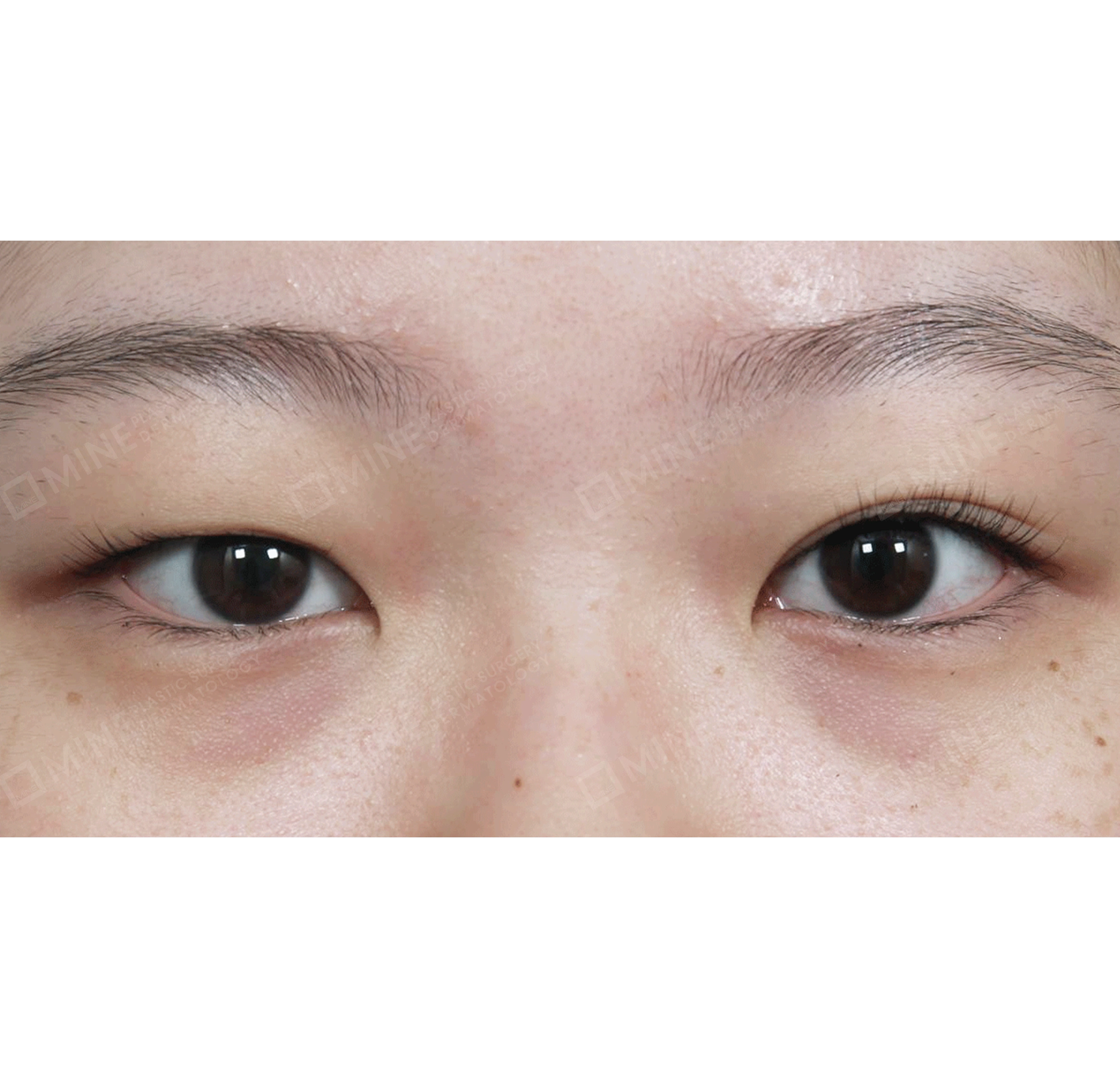 Eye Revision + Non-incision Ptosis Correction-정면-전