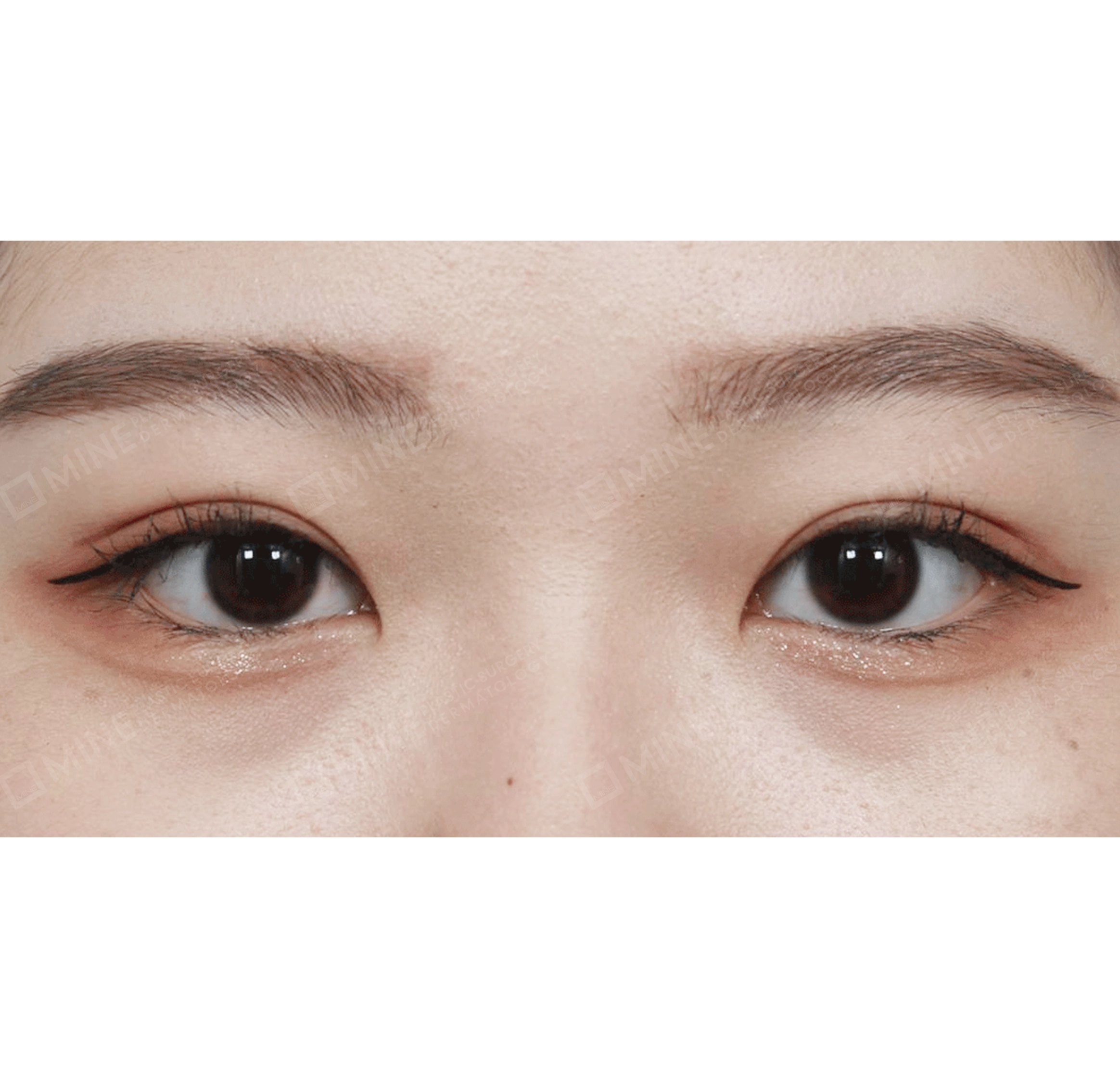 Eye Revision + Non-incision Ptosis Correction-정면-후