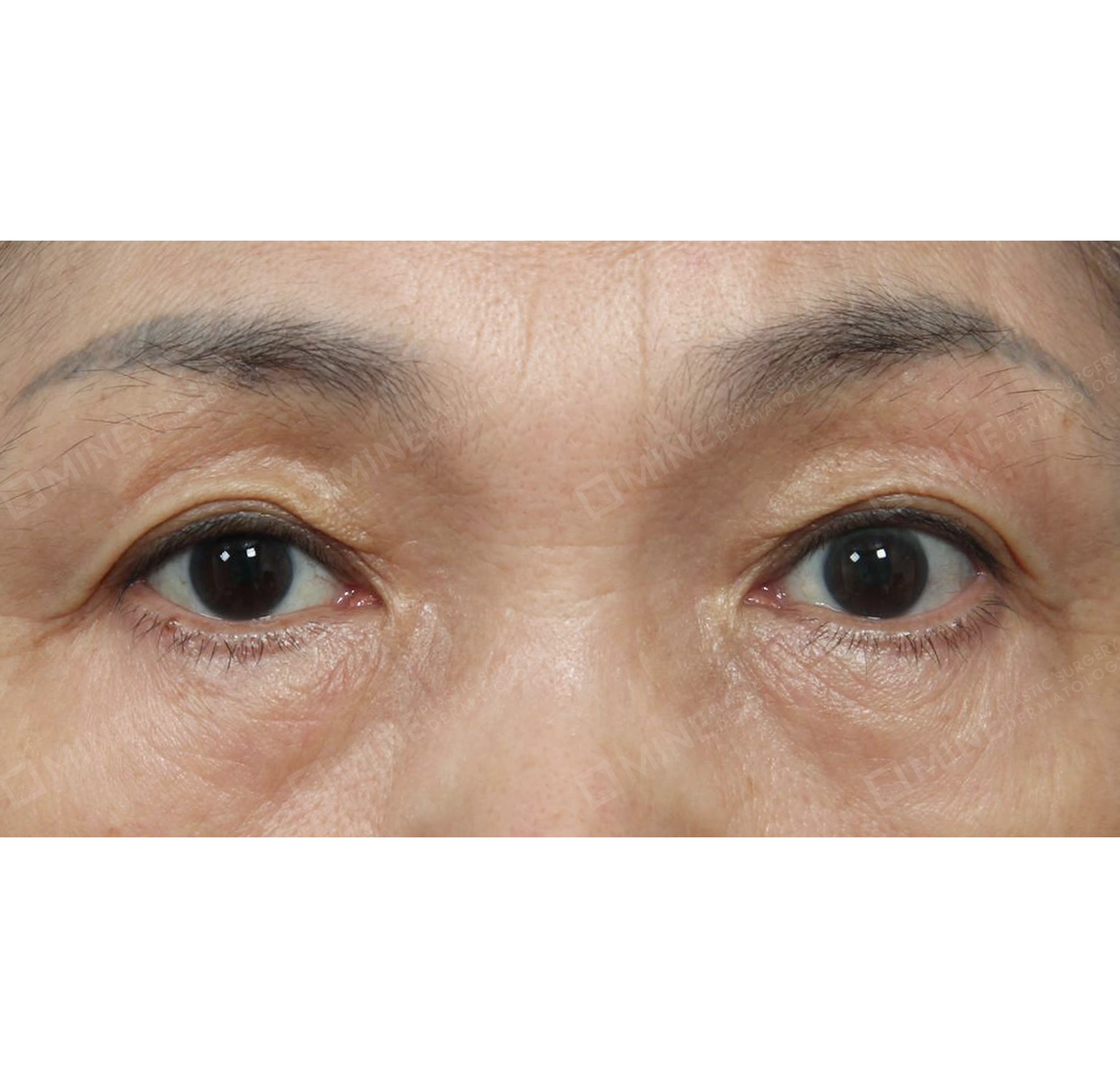 Subbrow Lift +  Under Eye Fat Repositioning-정면-전