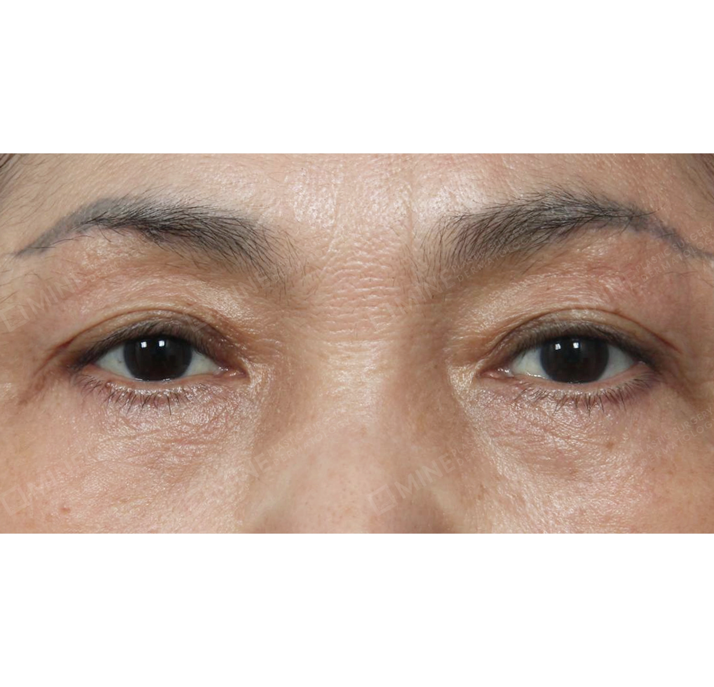 Subbrow Lift +  Under Eye Fat Repositioning-정면-후