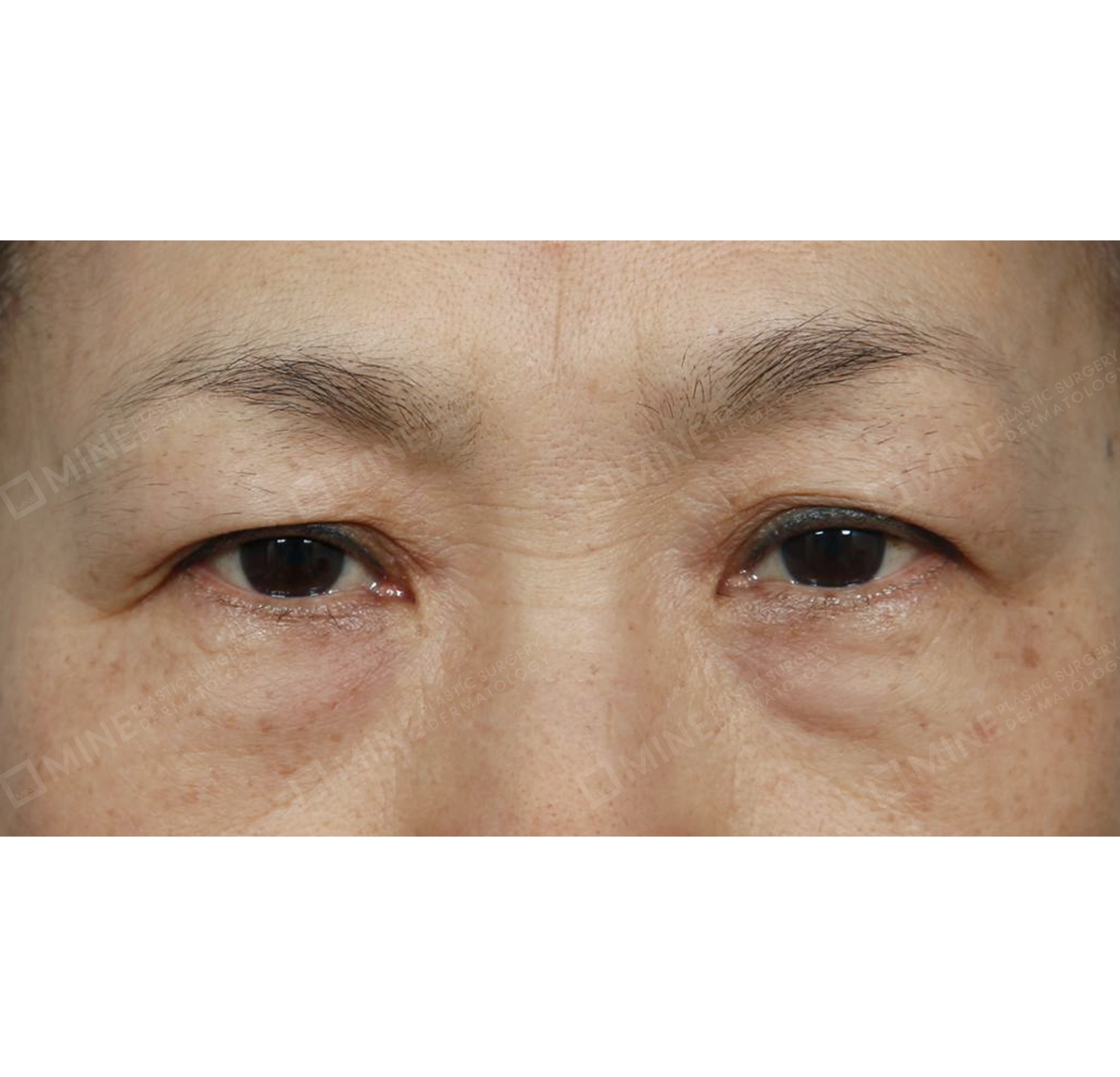 Subbrow Lift + Incision Ptosis Correction-정면-전