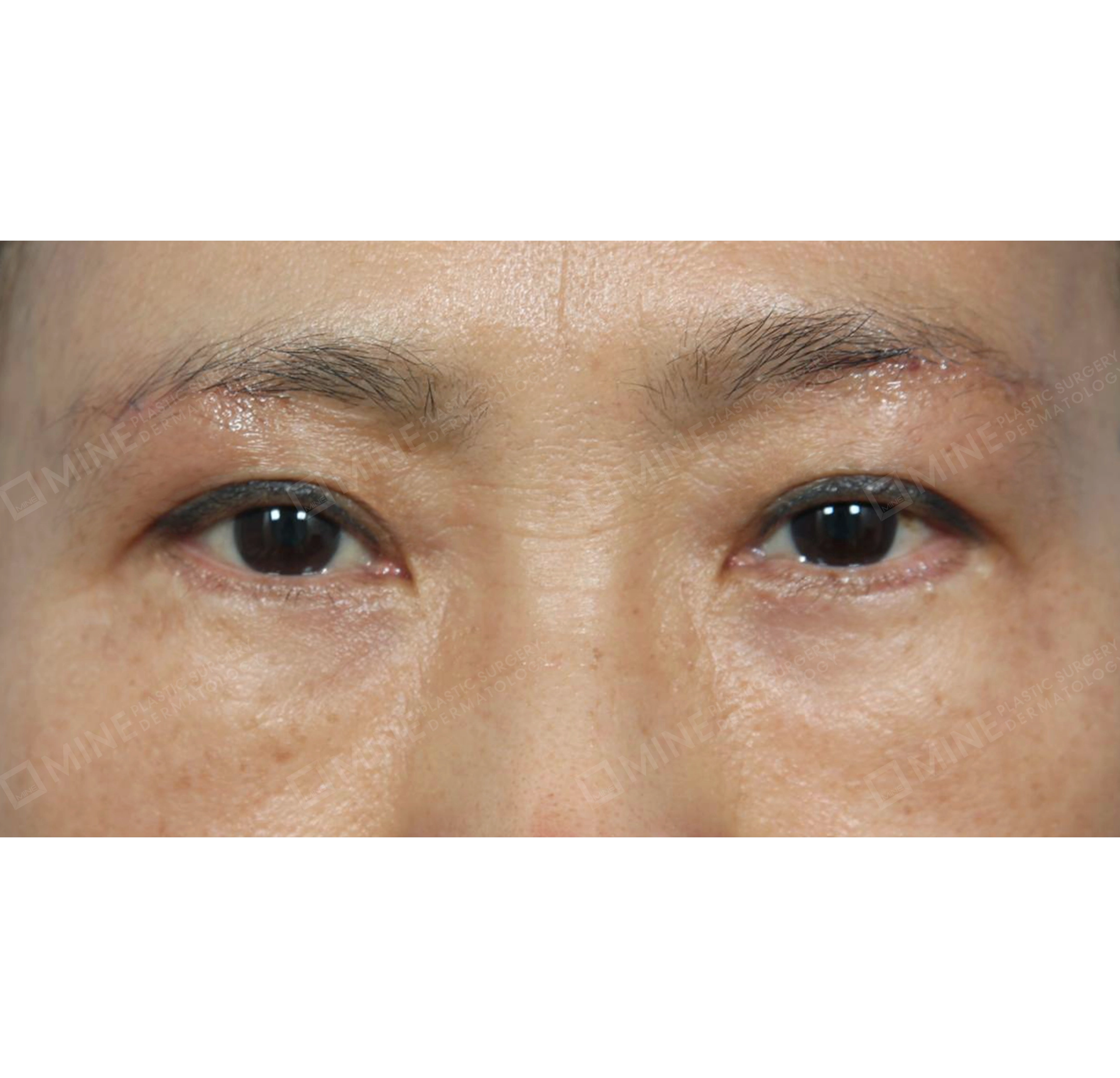 Subbrow Lift + Incision Ptosis Correction-정면-후
