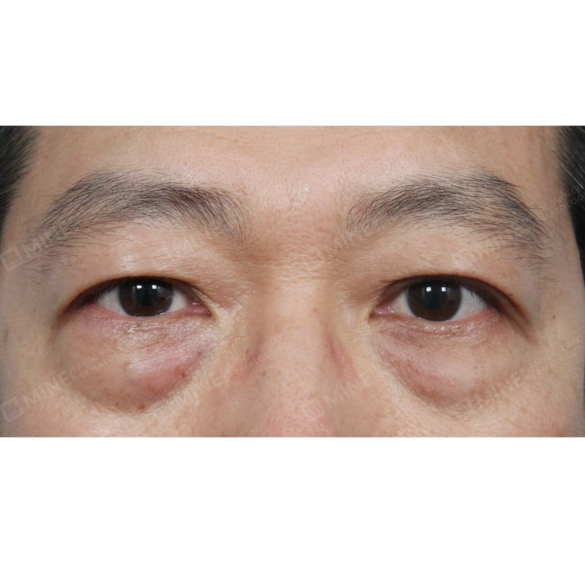 Under Eye Fat Repositioning-정면-전