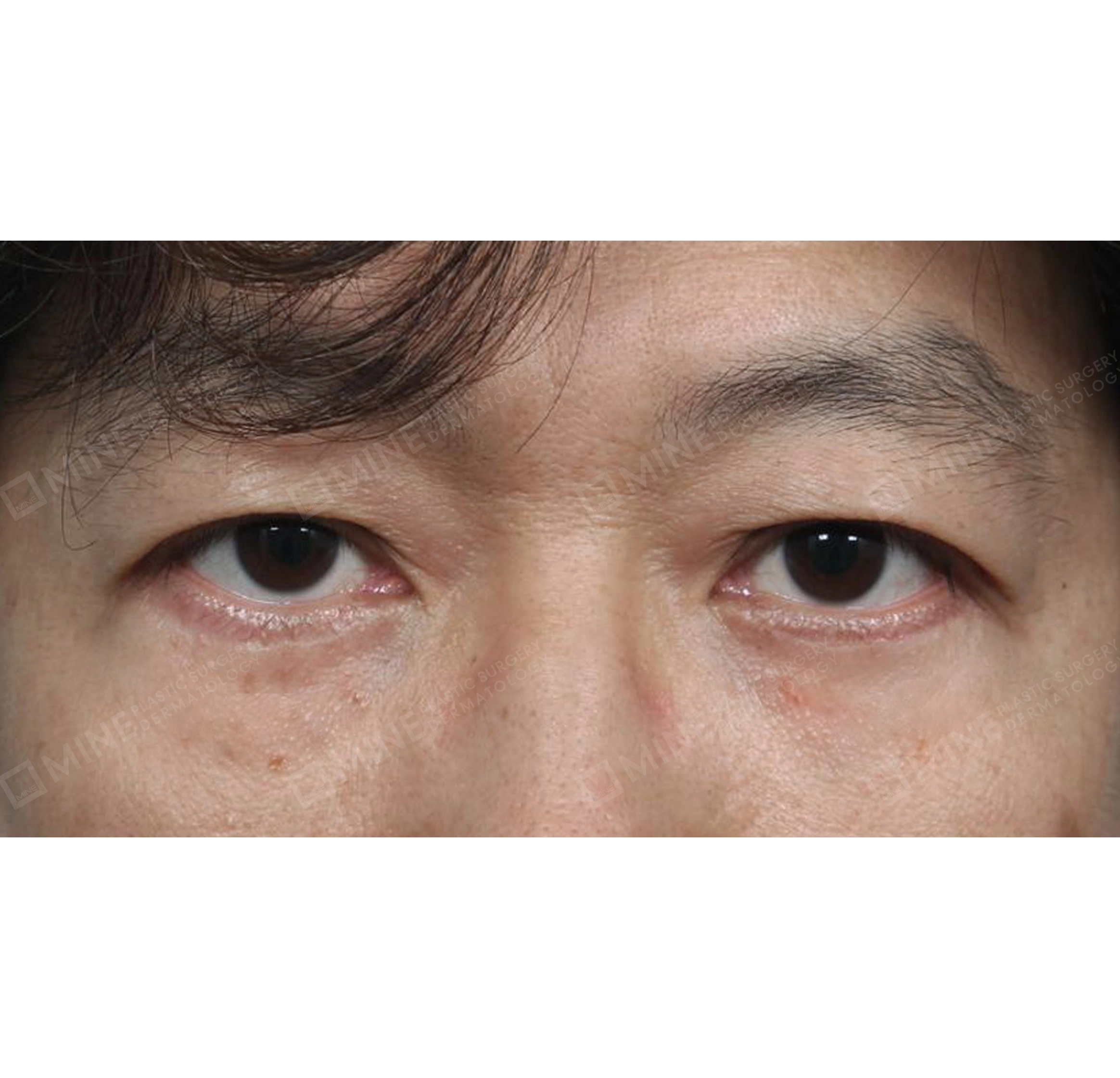 Under Eye Fat Repositioning-정면-후