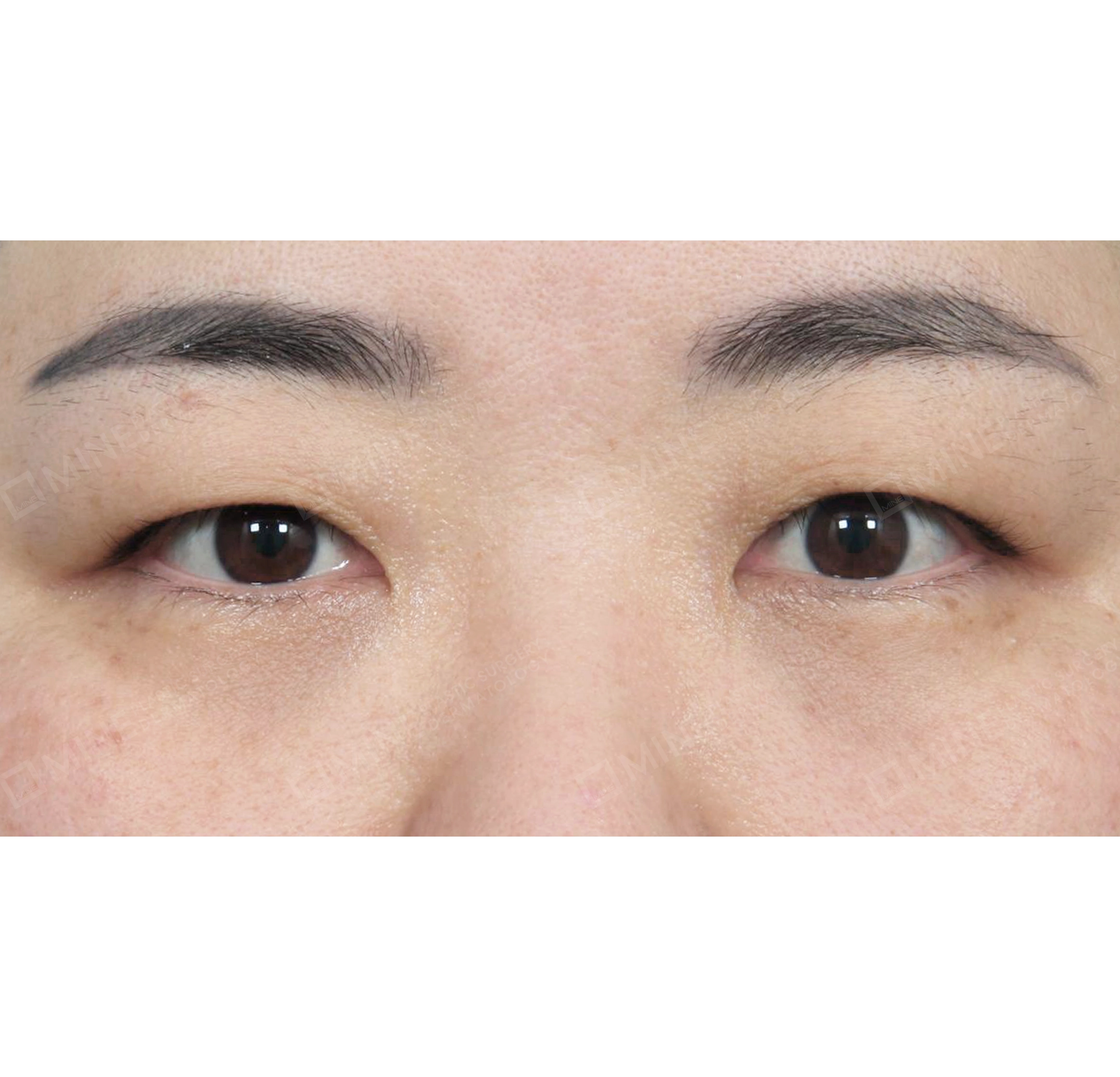 Incision Ptosis Correction-정면-전