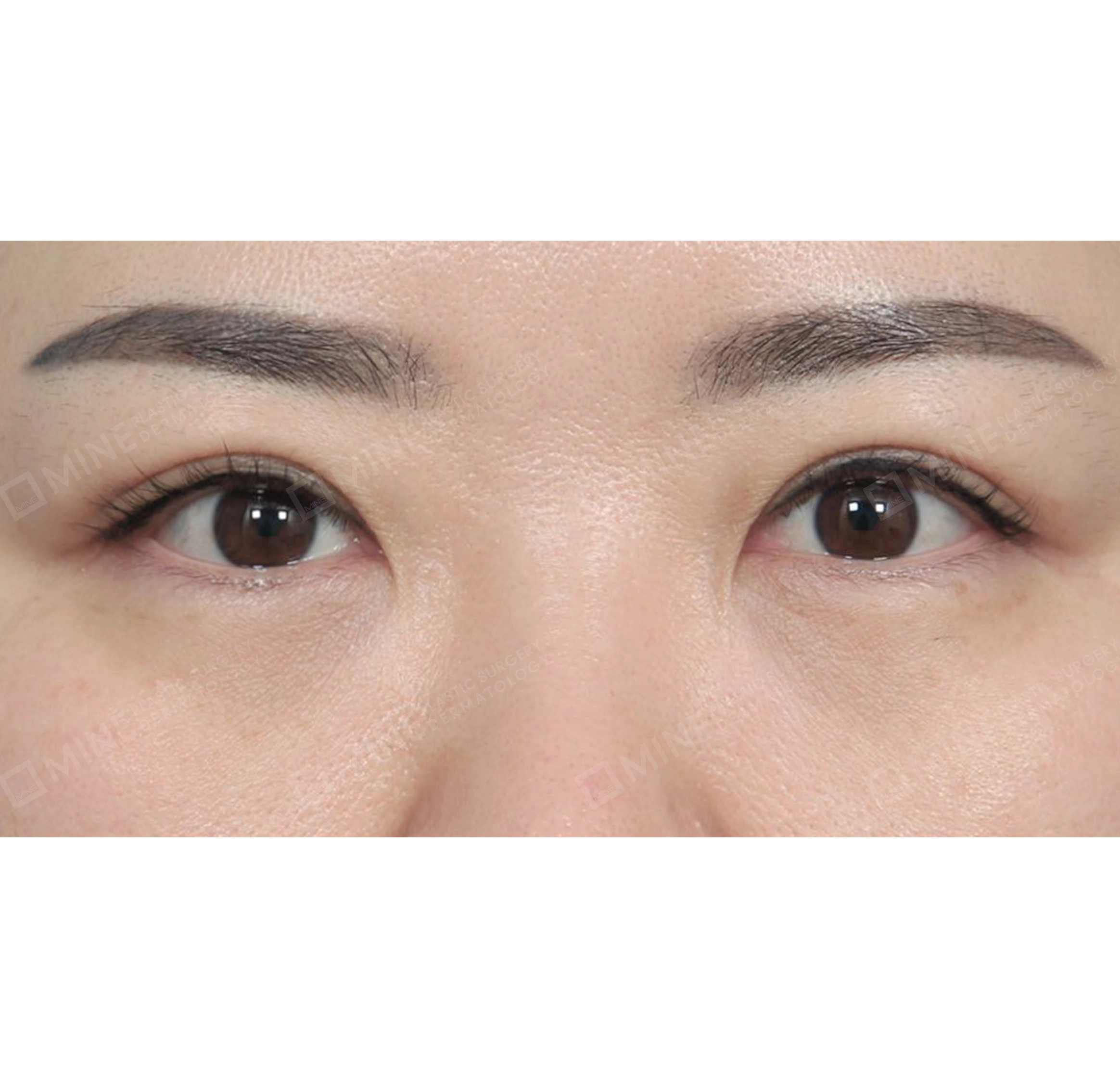 Incision Ptosis Correction-정면-후
