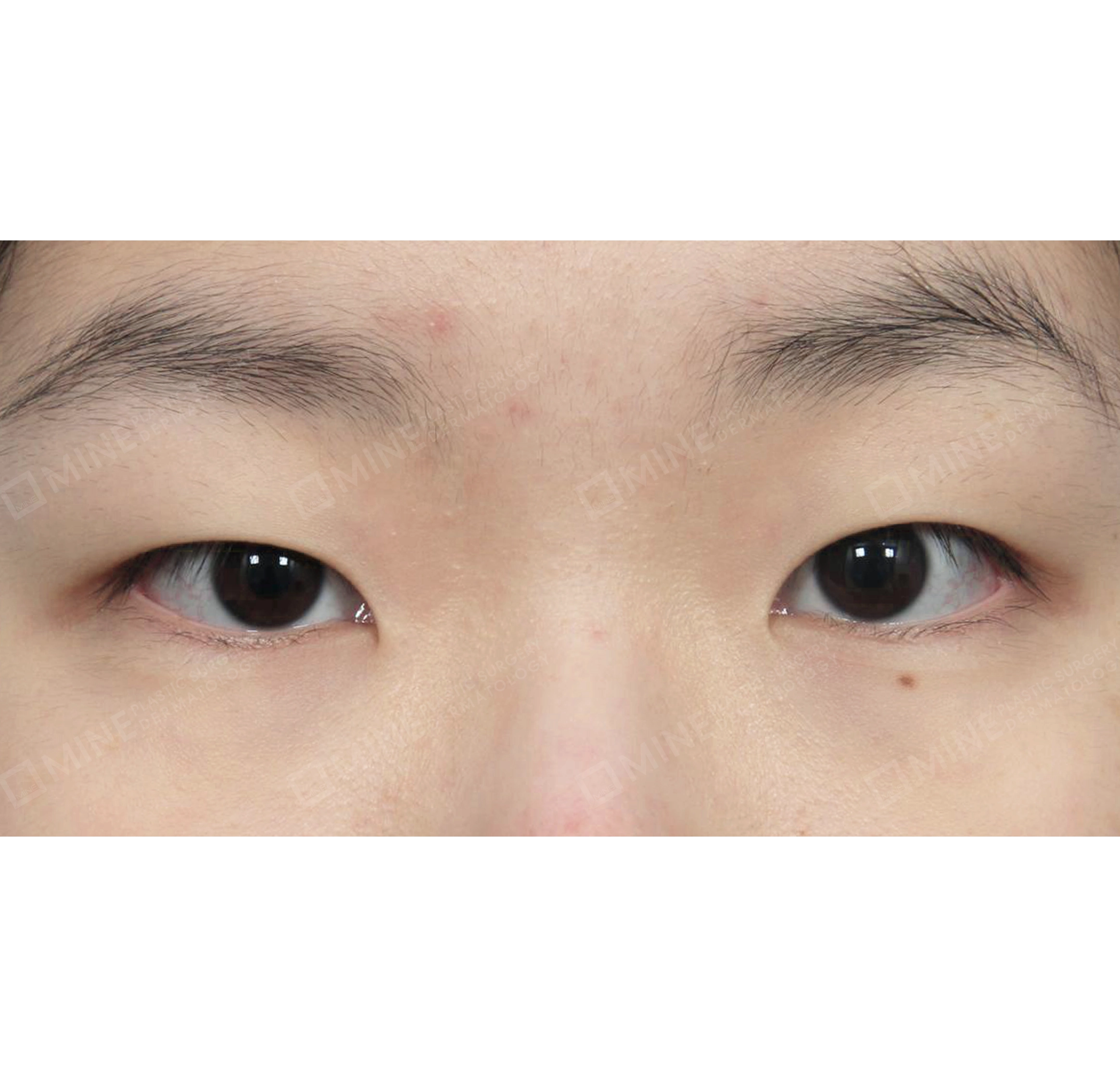 Ptosis Correction-정면-전