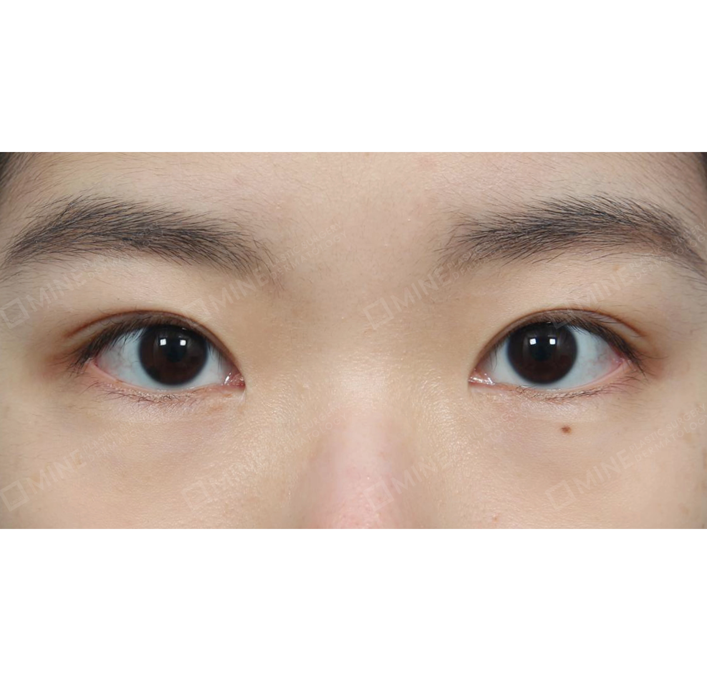 Ptosis Correction-정면-후