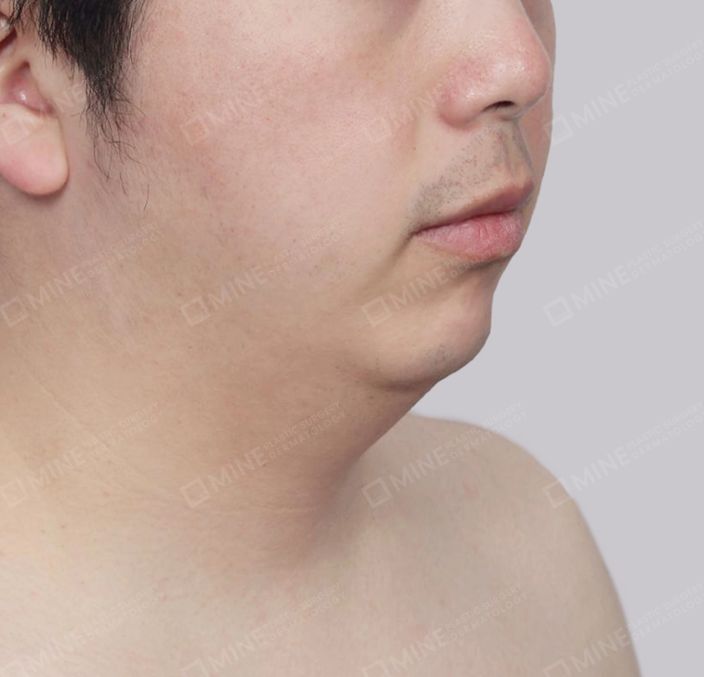 Double Chin (Vlimming)-정면-전