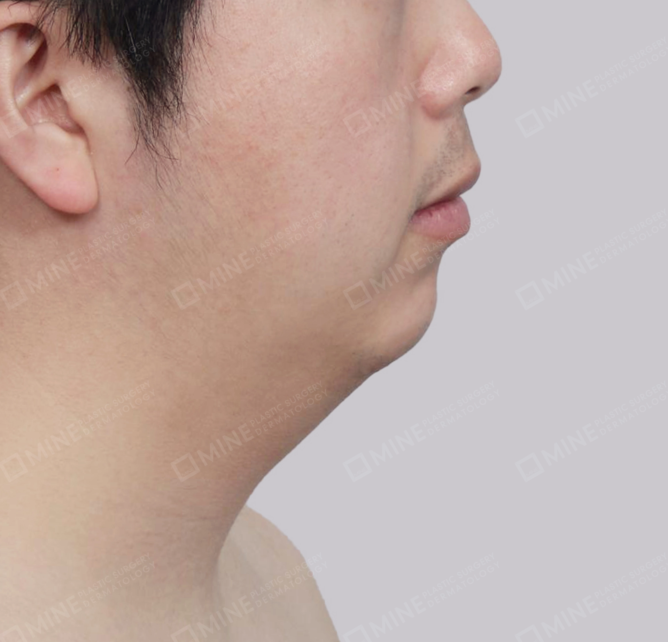 Double Chin (Vlimming)-측면-전