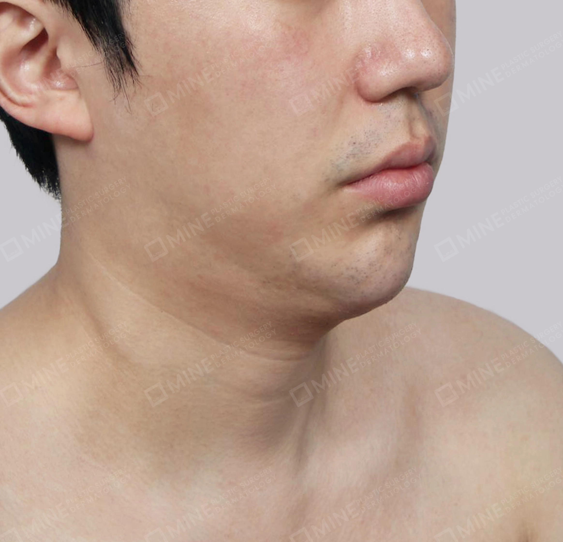 Double Chin (Vlimming)-정면-전