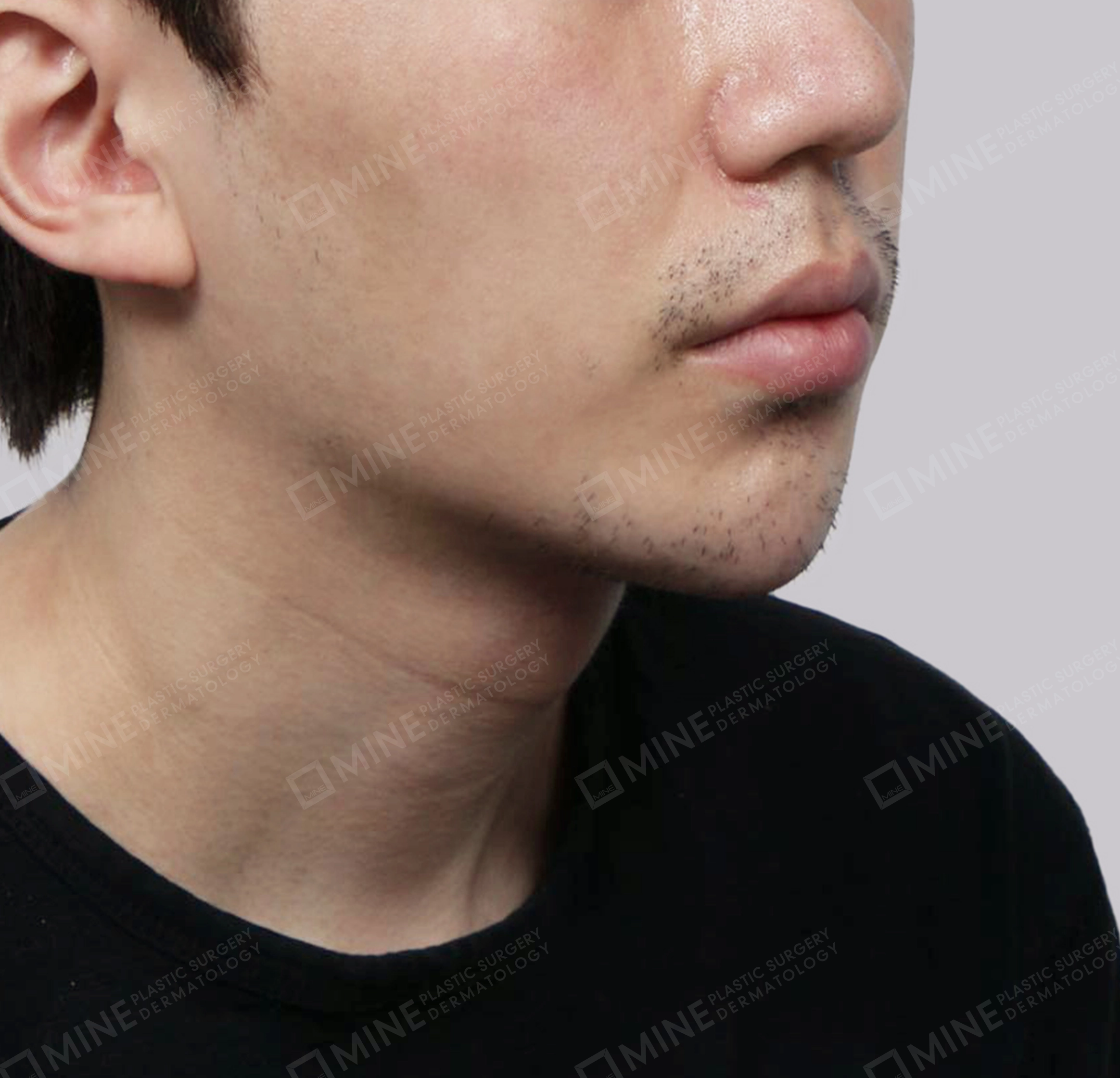 Double Chin (Vlimming)-정면-후