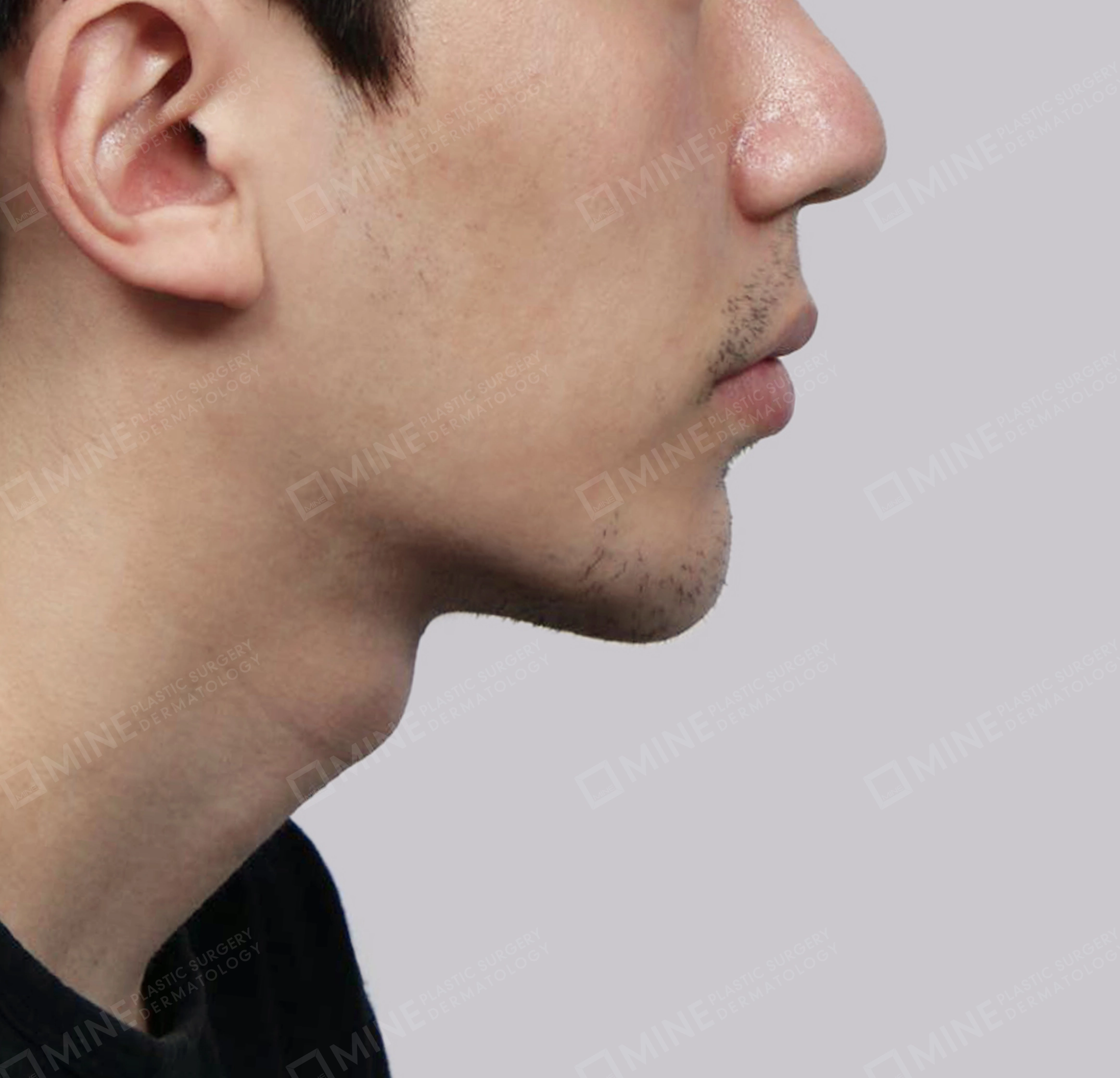Double Chin (Vlimming)-측면-후