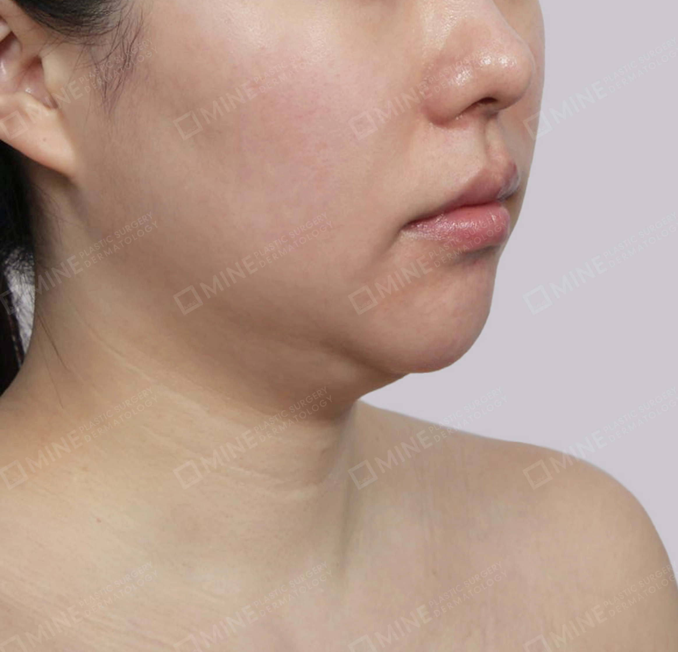 Double Chin (Vlimming)-정면-전