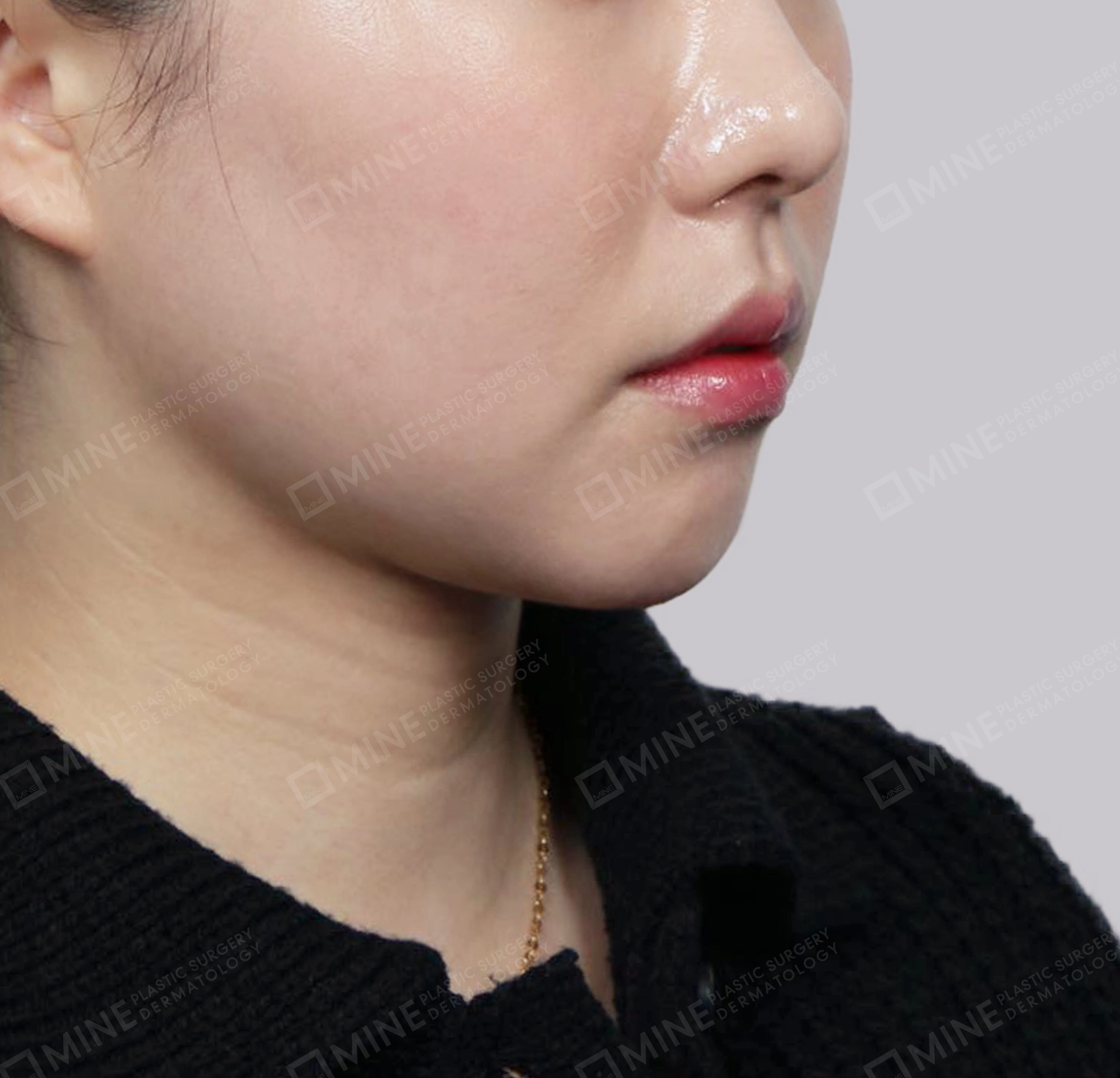Double Chin (Vlimming)-정면-후