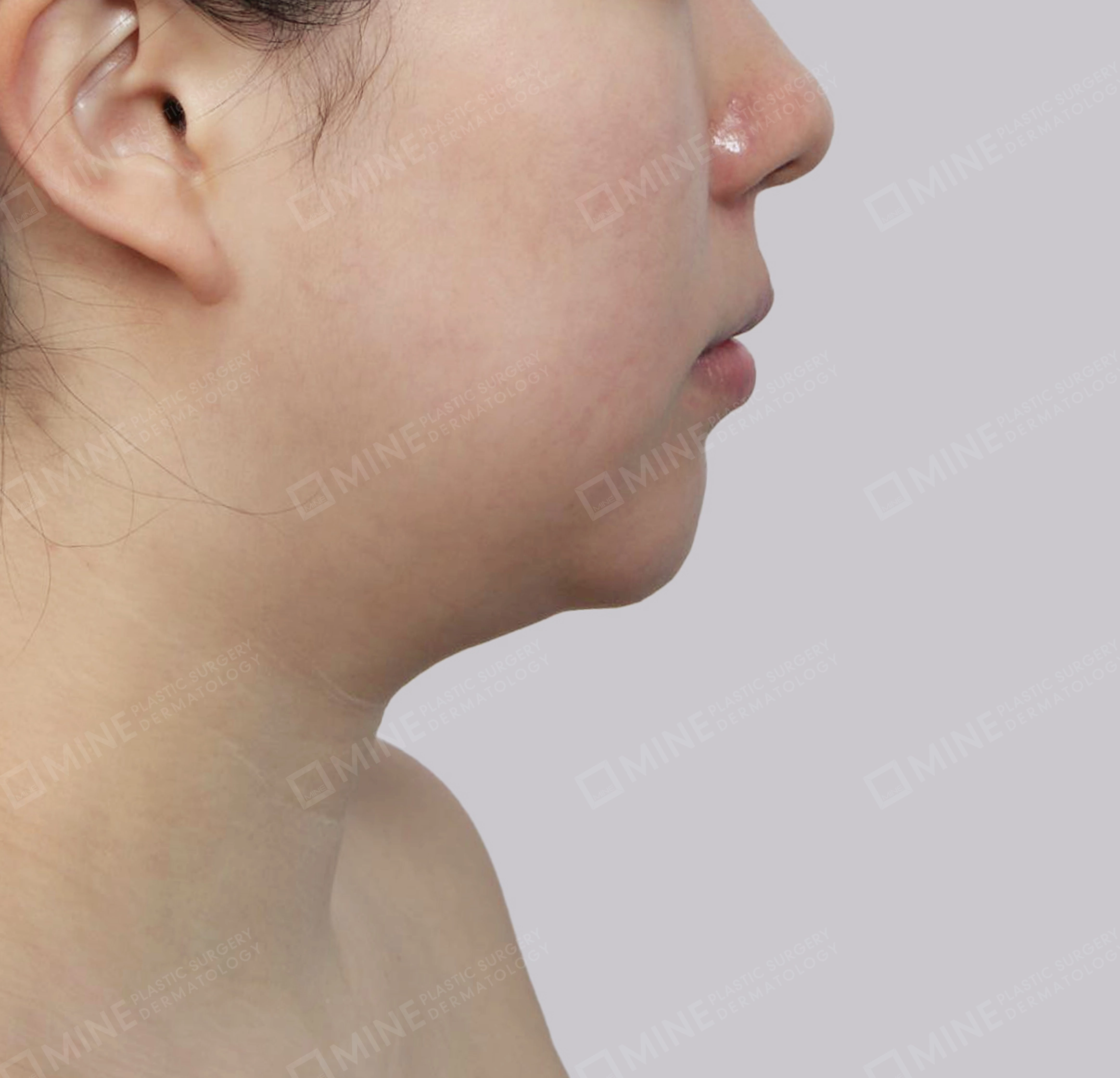 Double Chin (Vlimming)-측면-전