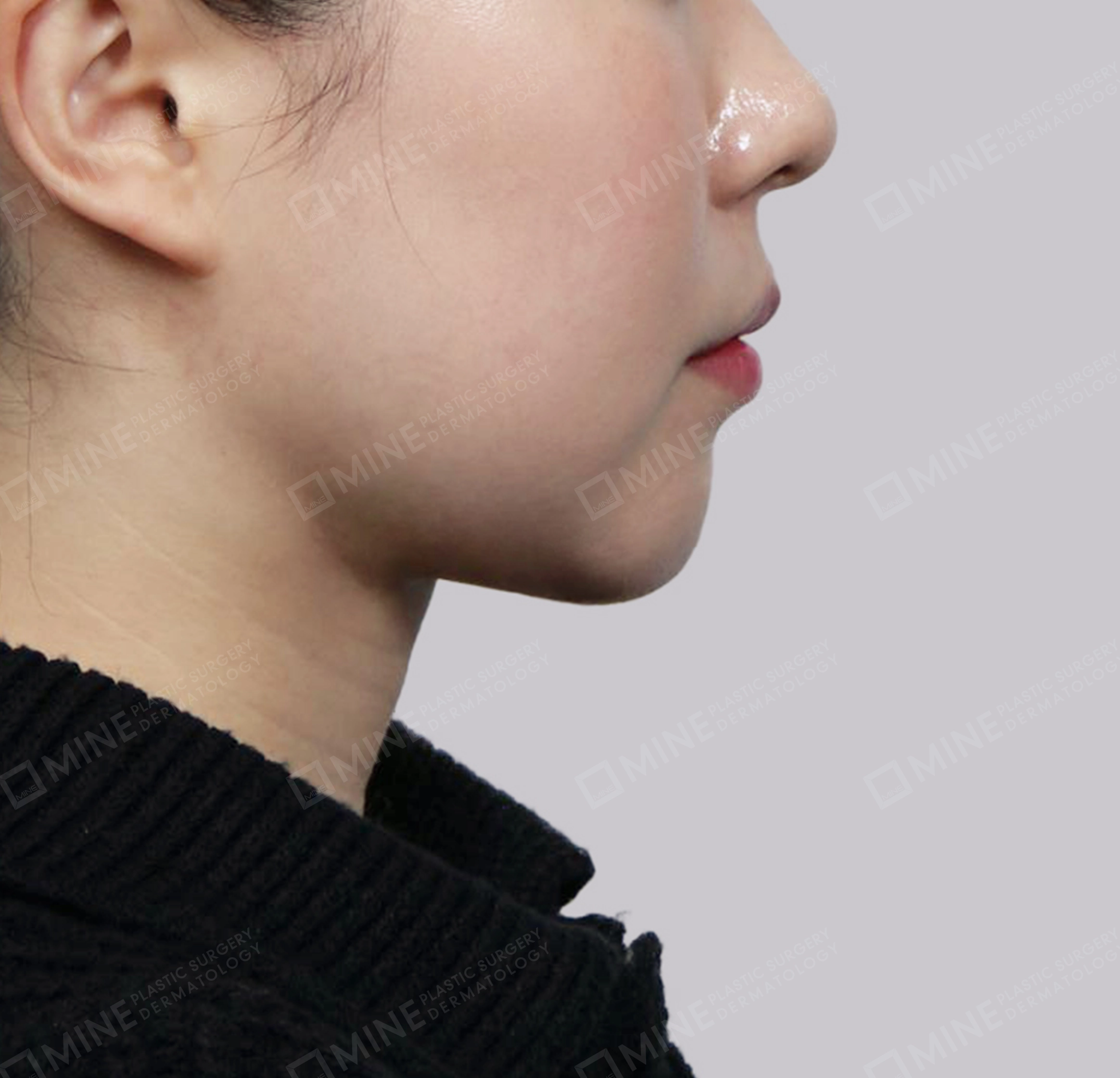 Double Chin (Vlimming)-측면-후