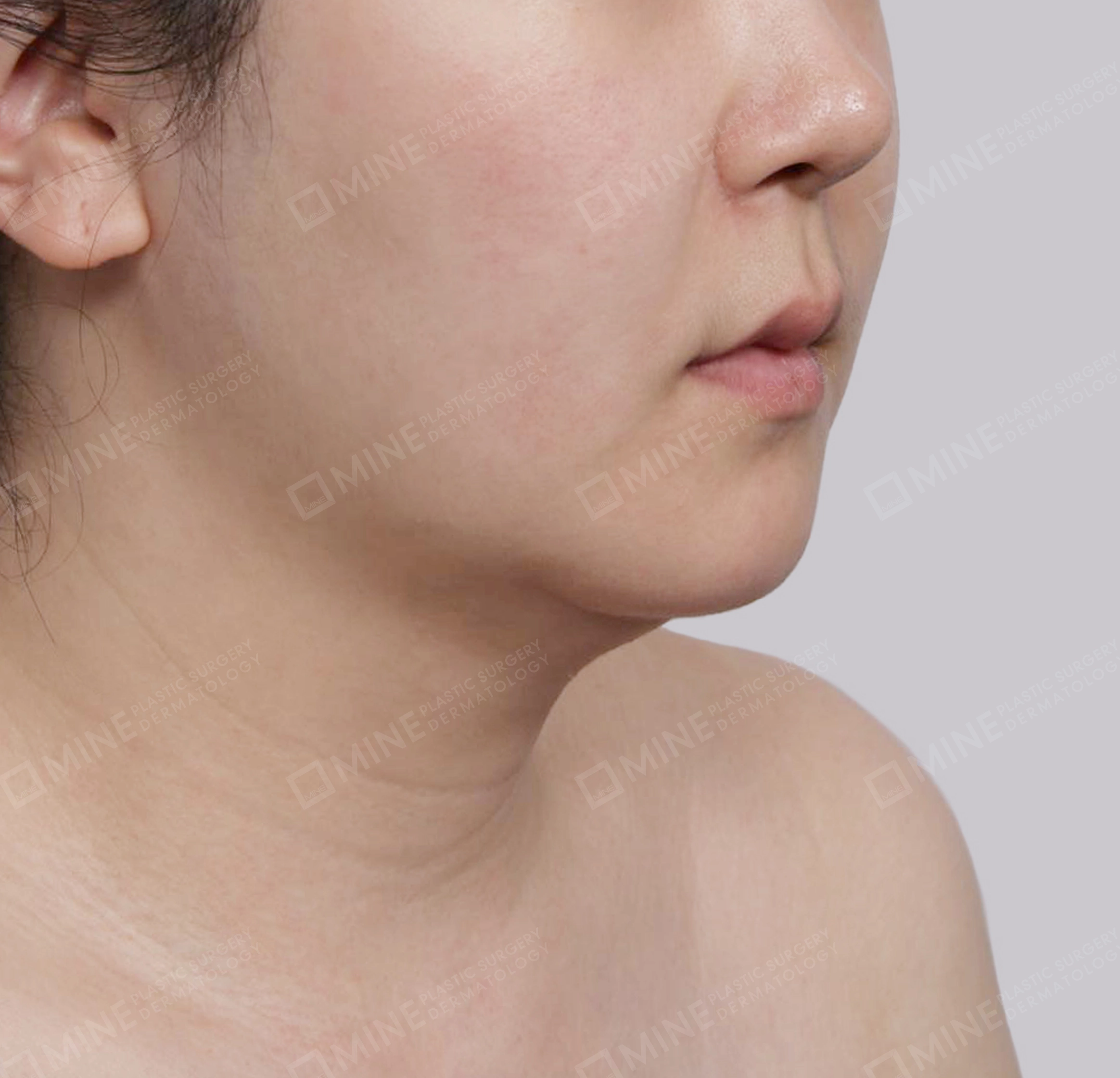 Mini Neck Lift-정면-전