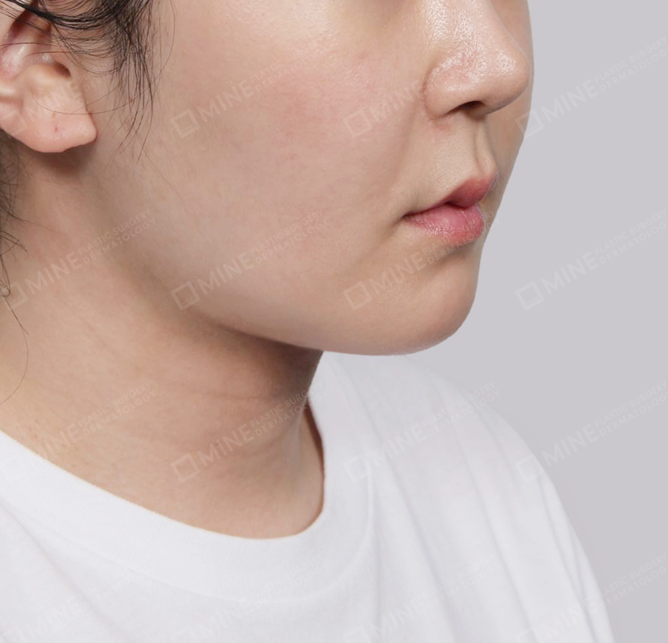 Mini Neck Lift-정면-후